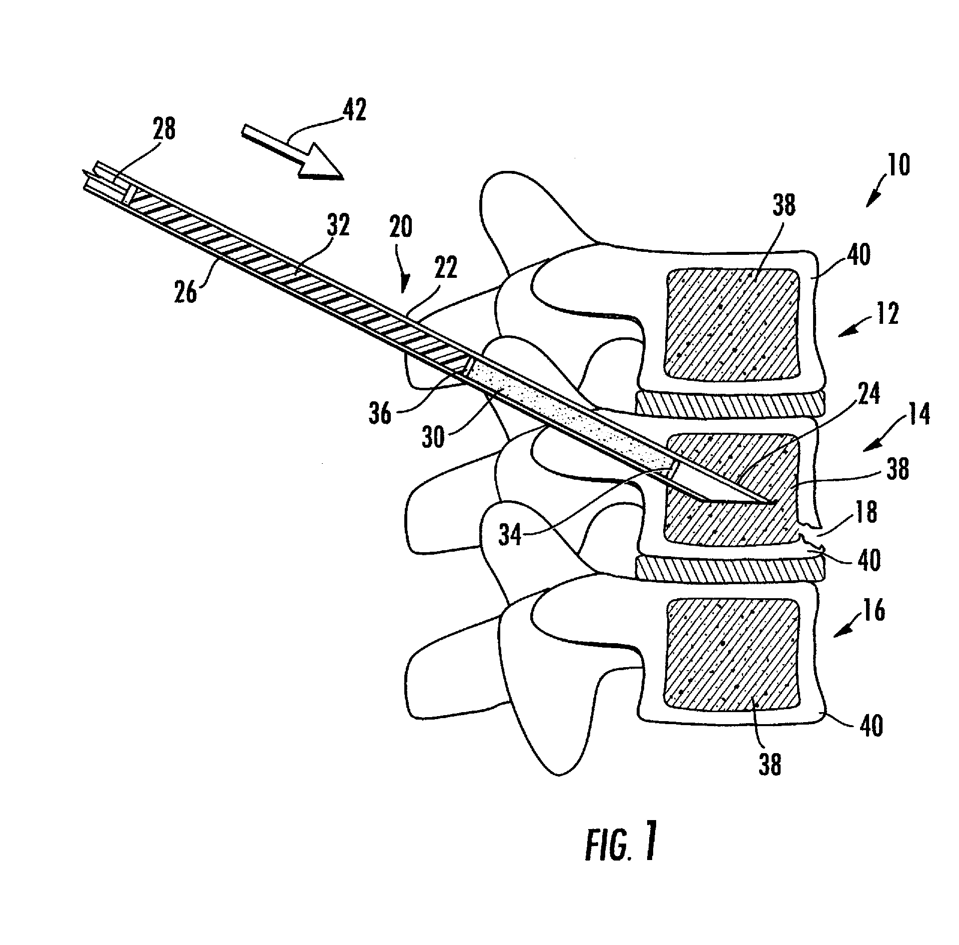 Method and composition for use in reinforcing bone