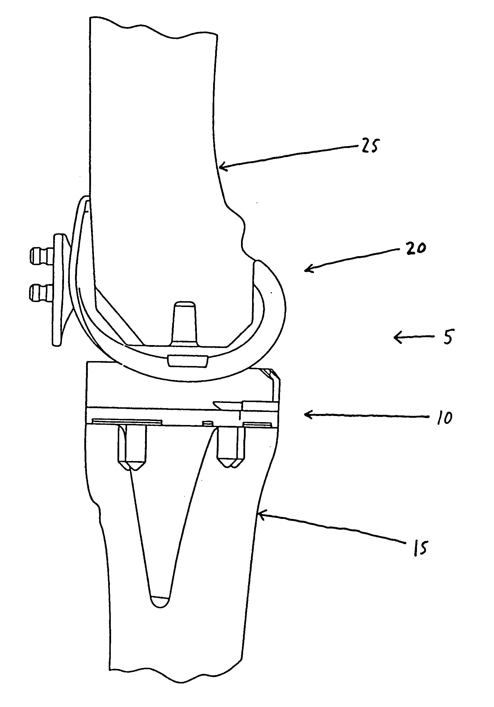 Bimetal tibial component construct for knee joint prosthesis