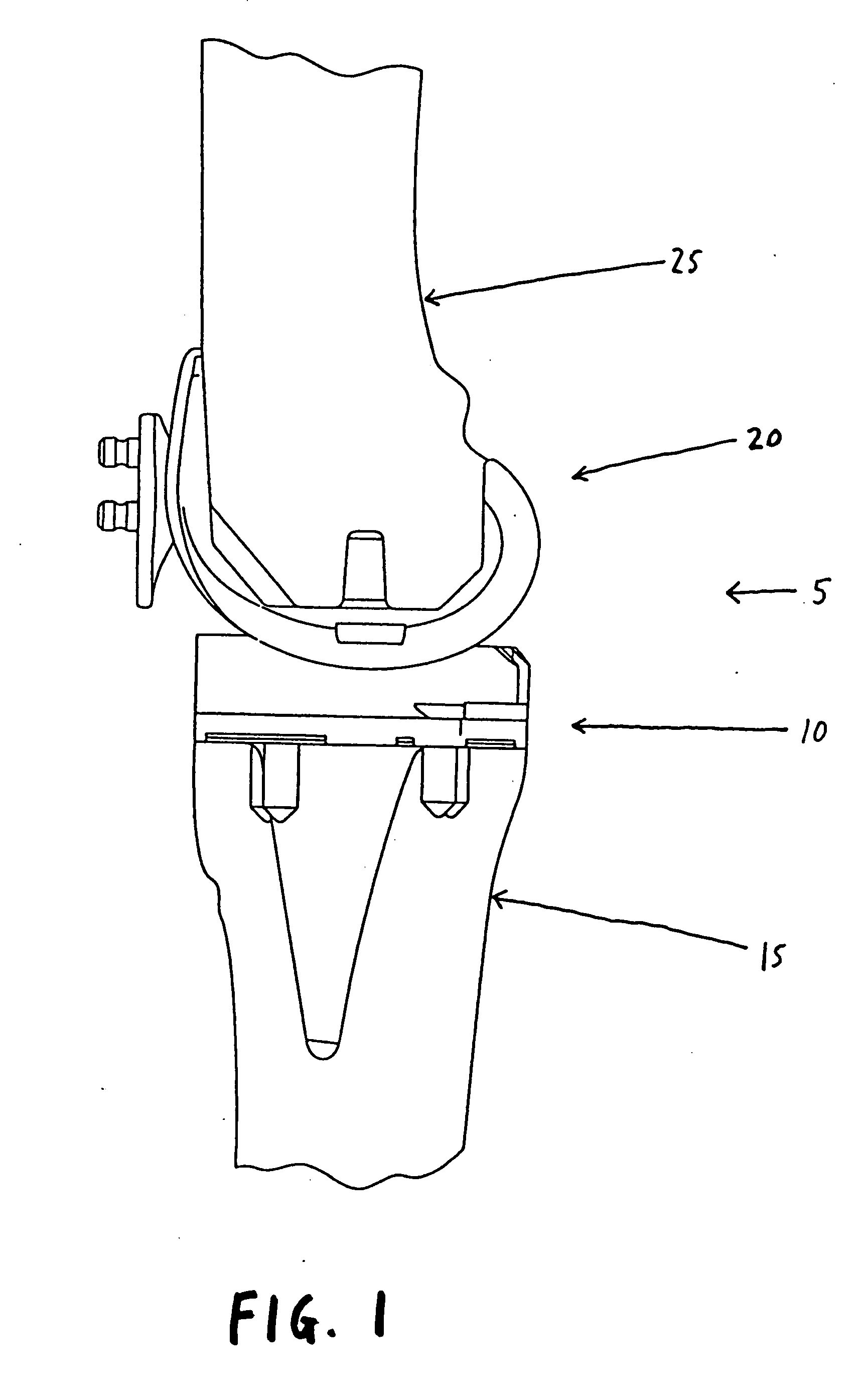 Bimetal tibial component construct for knee joint prosthesis