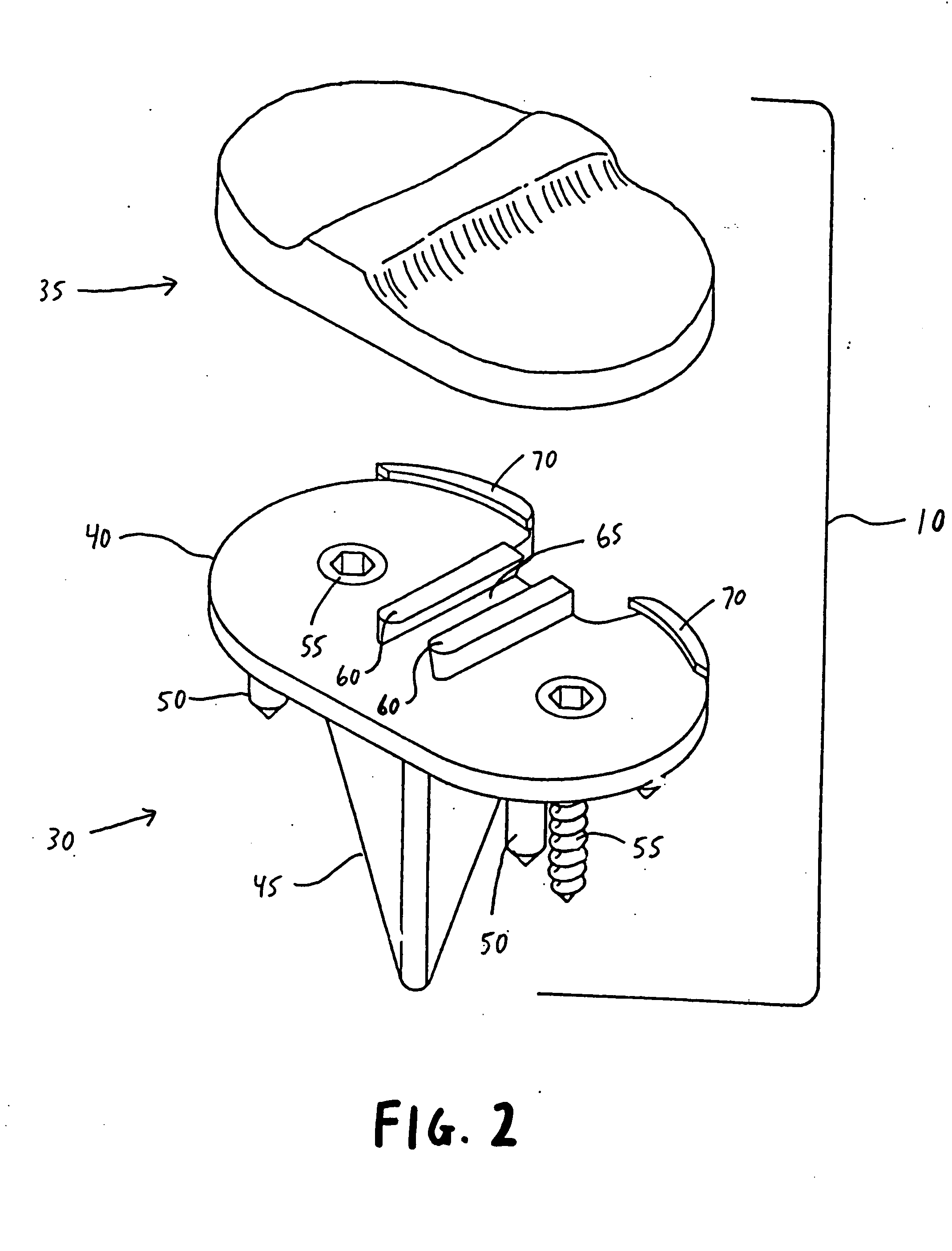 Bimetal tibial component construct for knee joint prosthesis