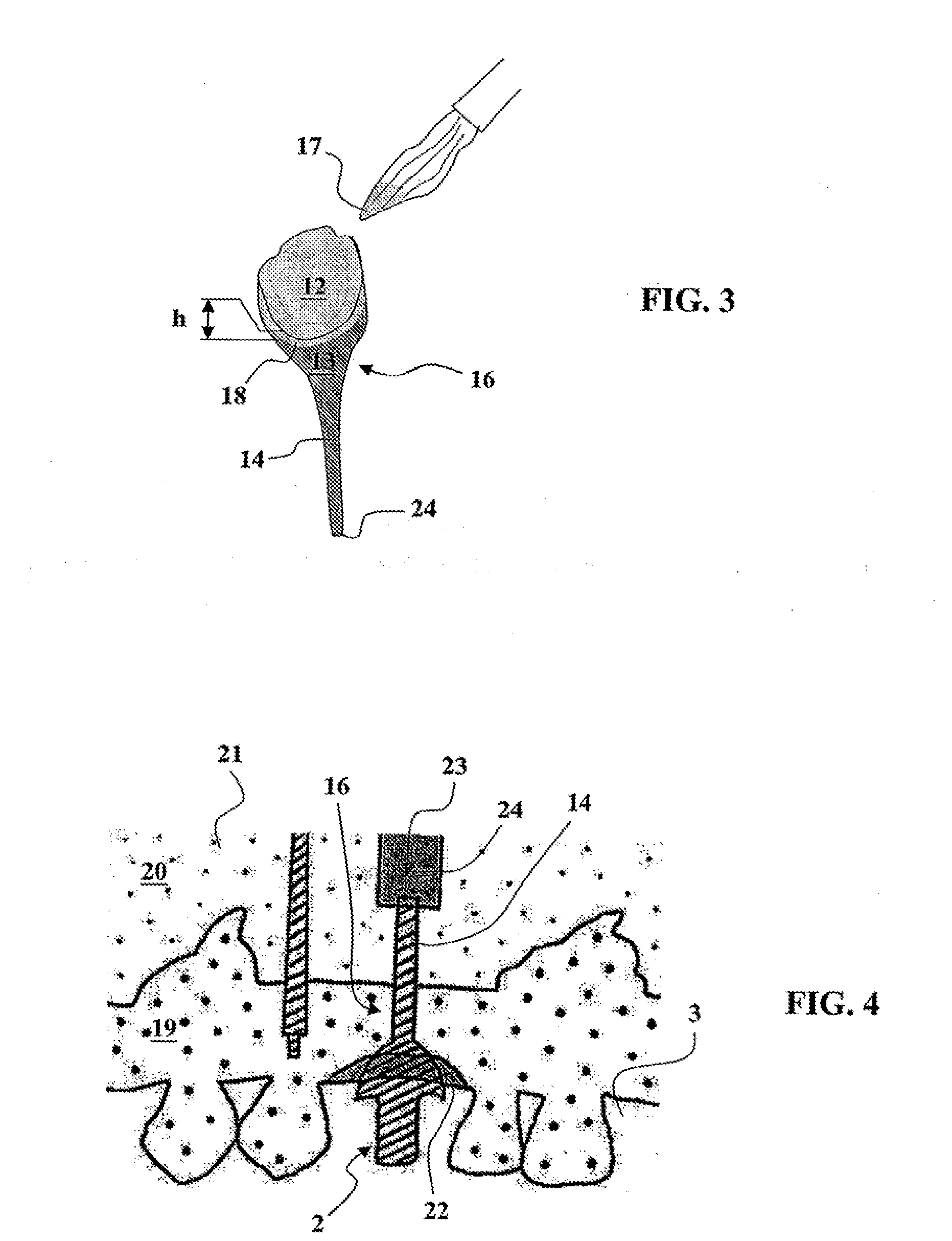 Ceramic Dental Prosthesis, Method and Device For Making Same