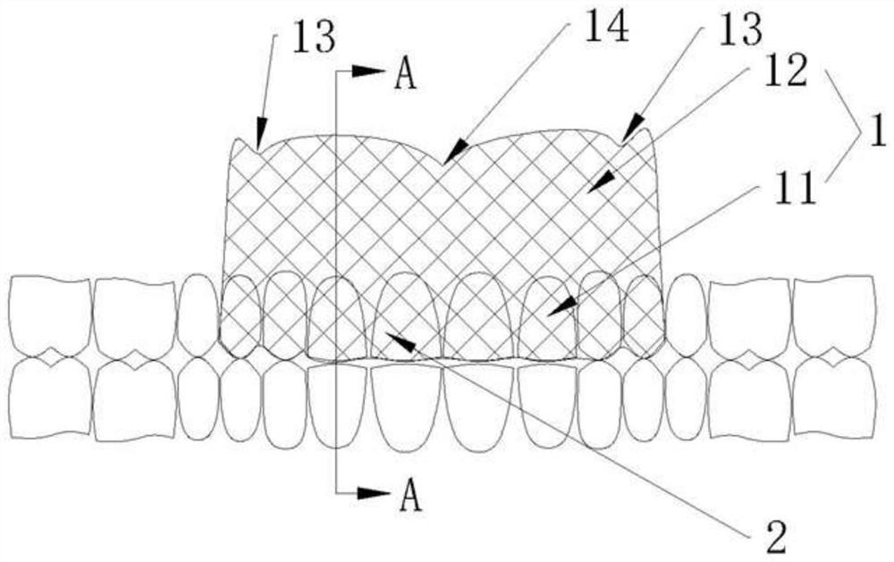 Digital shield plate for maintaining anterior tooth beauty area