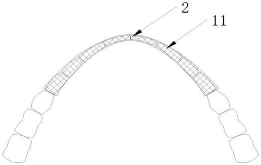 Digital shield plate for maintaining anterior tooth beauty area