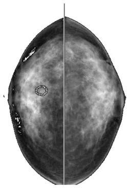 Mammary gland X-ray image antisymmetric generation analysis model training method and device