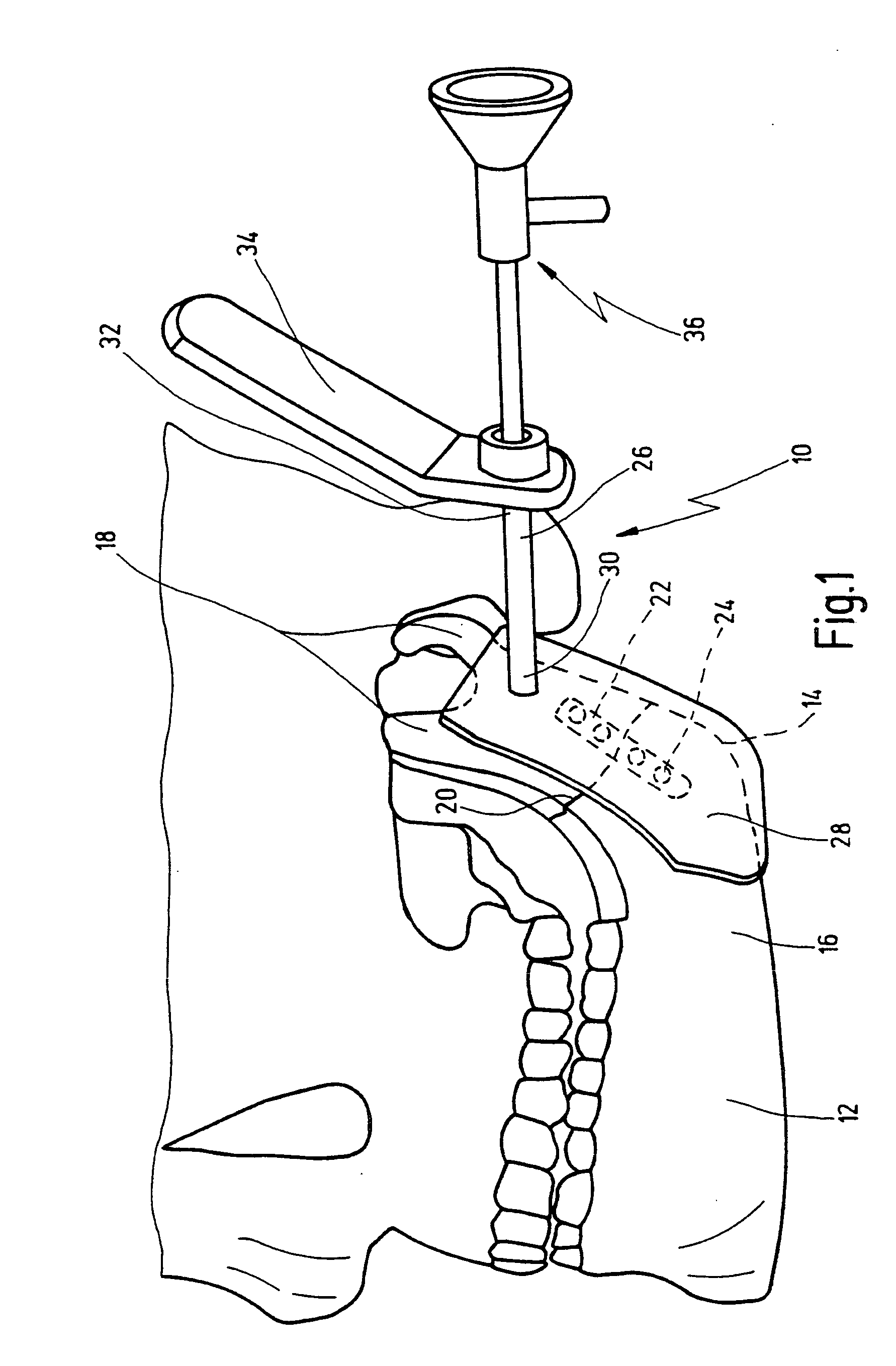 Medical instrument set and method for creating a surgical operating space in operations on the jaw