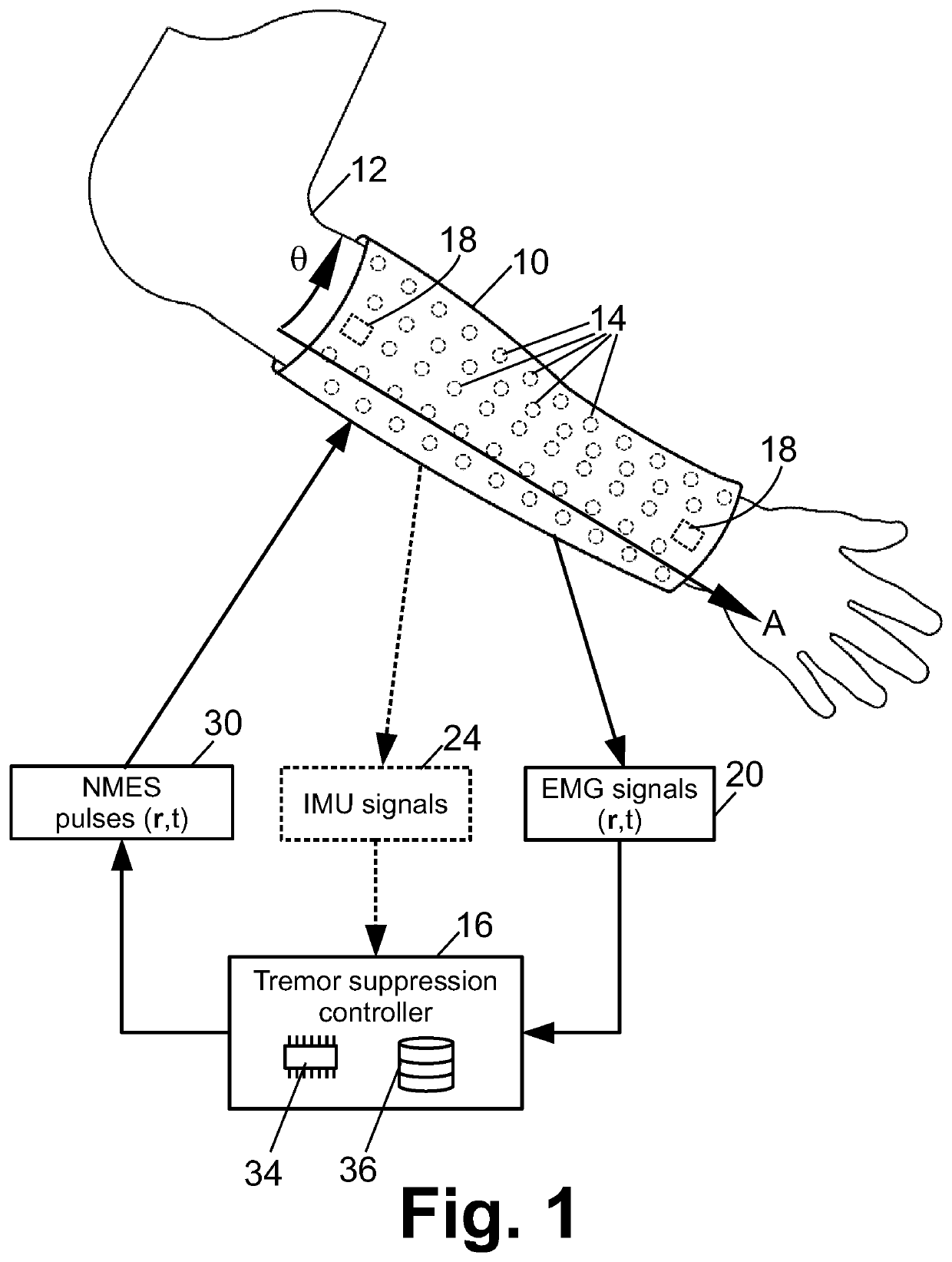 Neurosleeve for closed loop emg-fes based control of pathological tremors