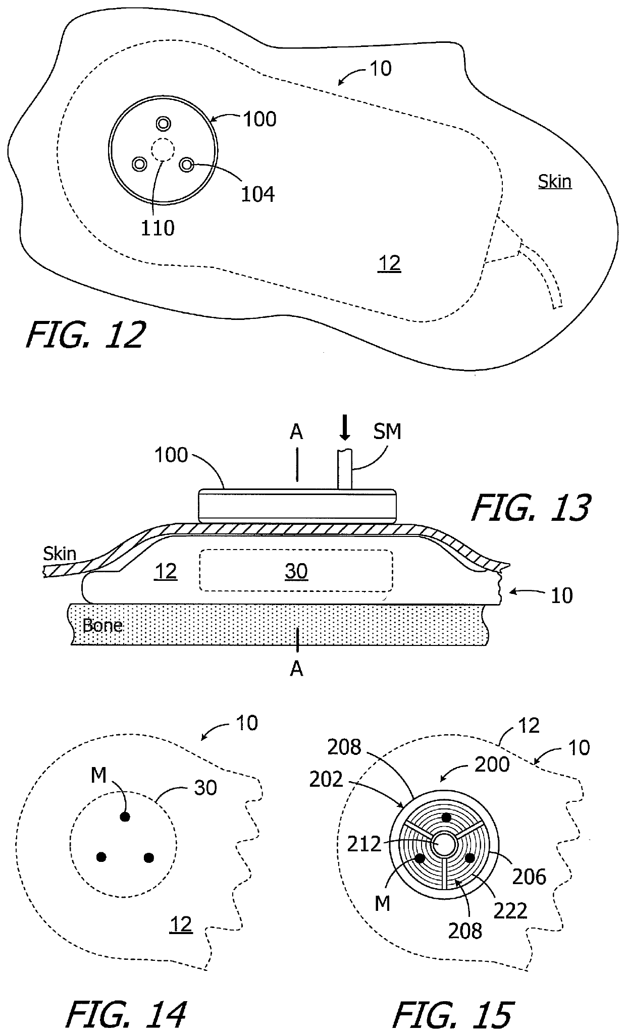 Methods and apparatus for use with cochlear implants having magnet apparatus with magnetic material particles