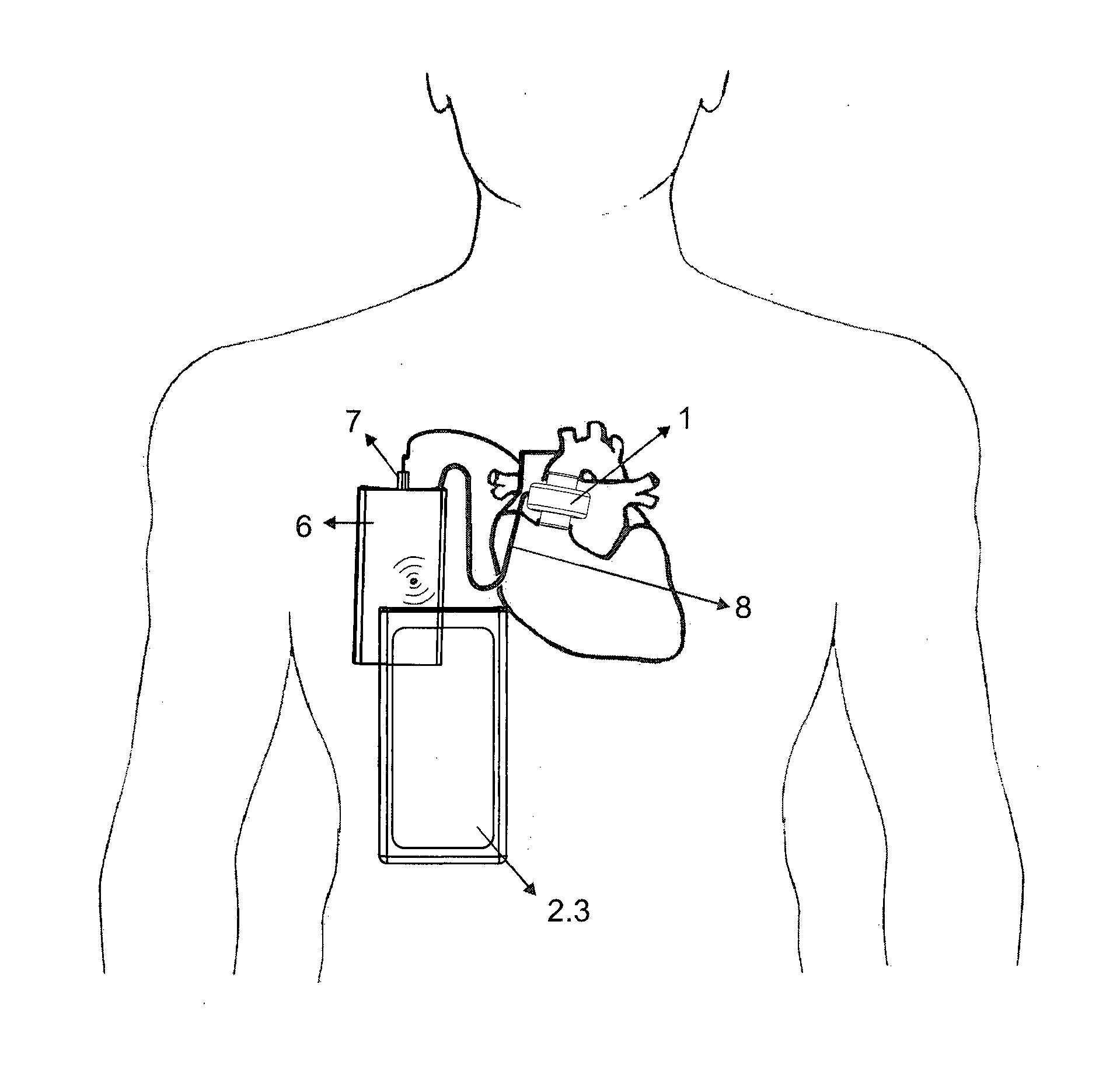 Transarterial heart assist device