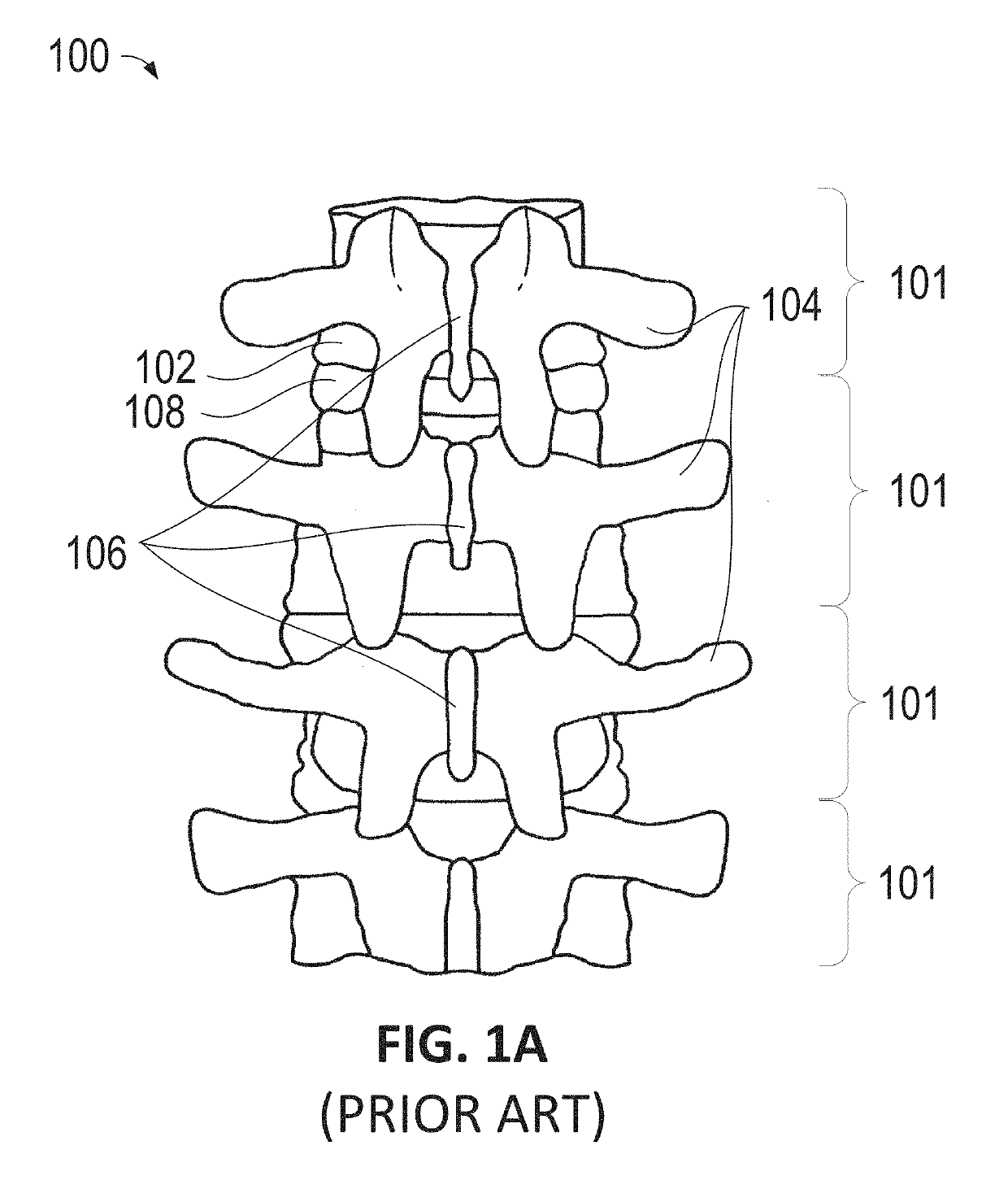 Method and apparatus for inhibiting proximal junctional failure