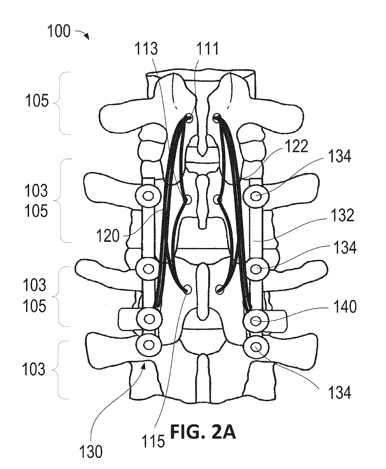 Method and apparatus for inhibiting proximal junctional failure