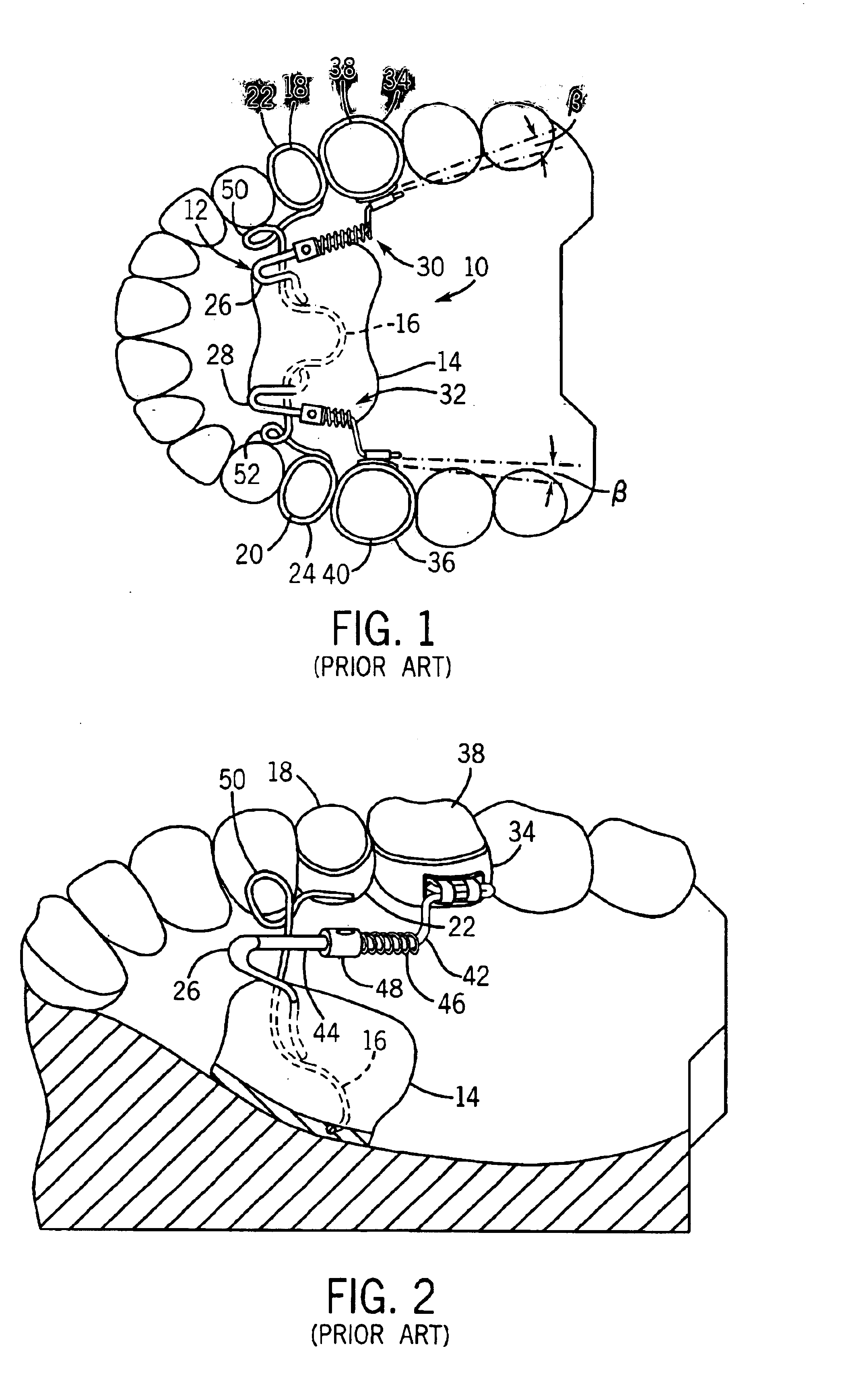 Orthodontic distalizing apparatus