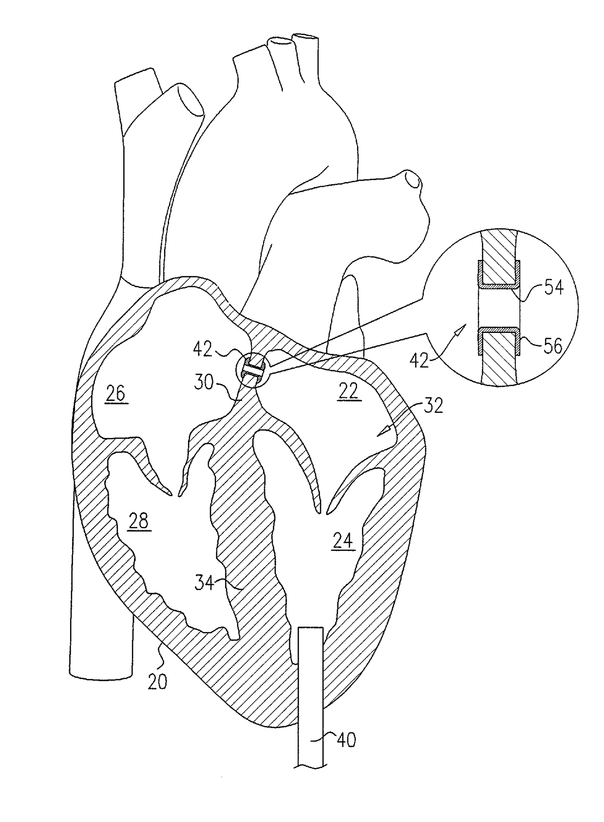 Techniques for providing a replacement valve and transseptal communication