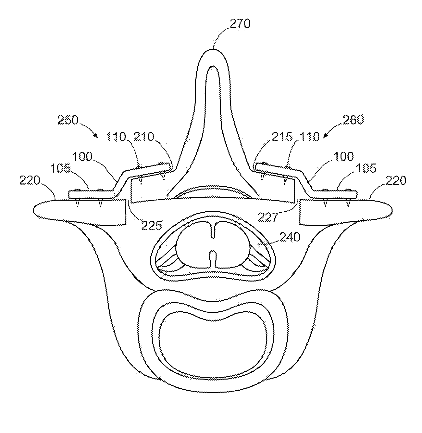 Laminoplasty system