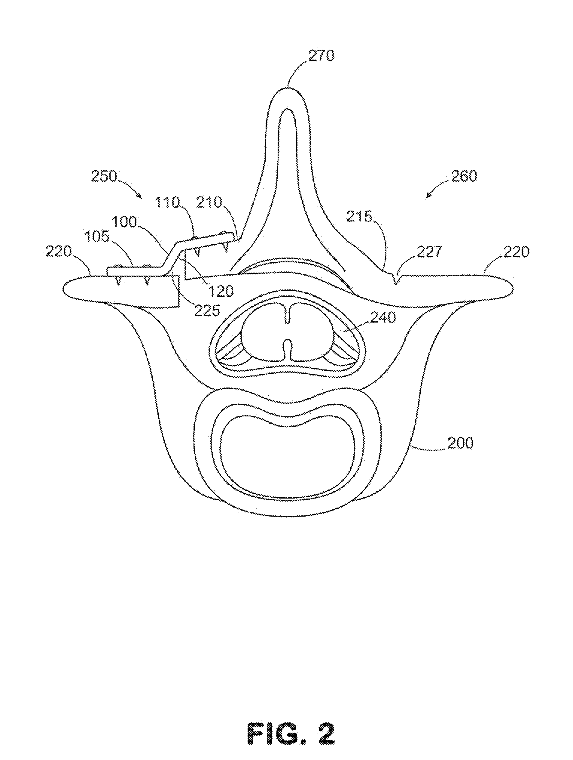 Laminoplasty system