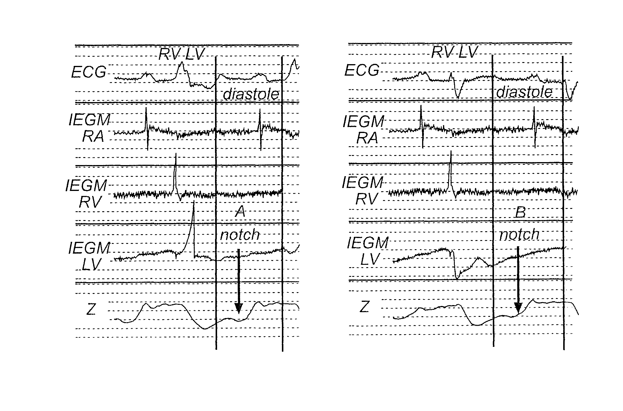 Implantable medical device and method for monitoring synchronicity of the ventricles of a heart