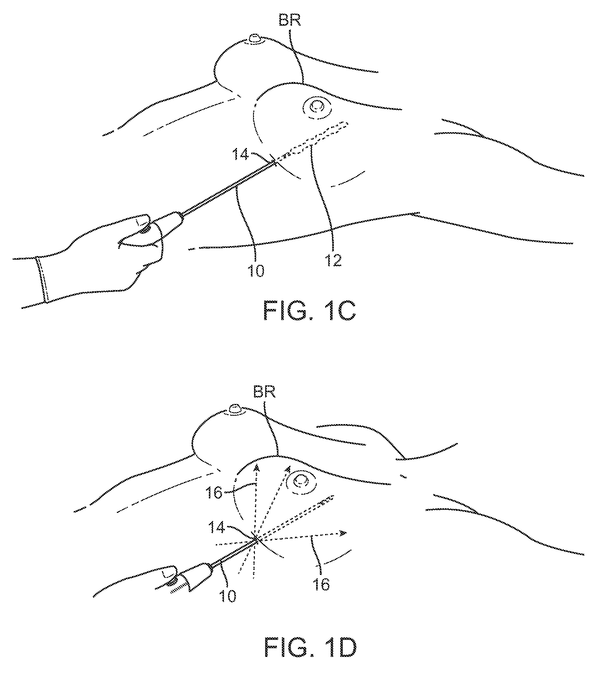 Devices and methods for tissue transfer