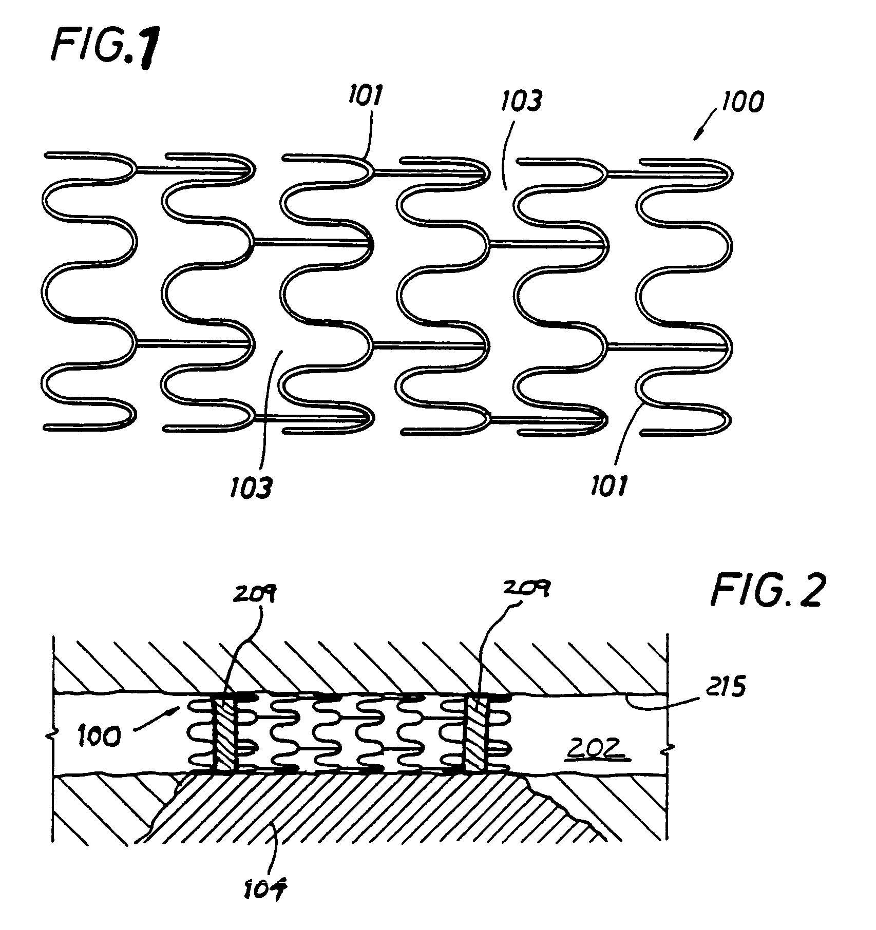 Composite stent with regioselective material and a method of forming the same