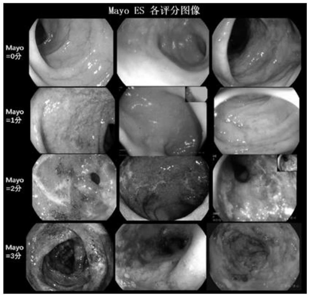 Method and system for evaluating the severity of ulcerative colitis based on deep learning