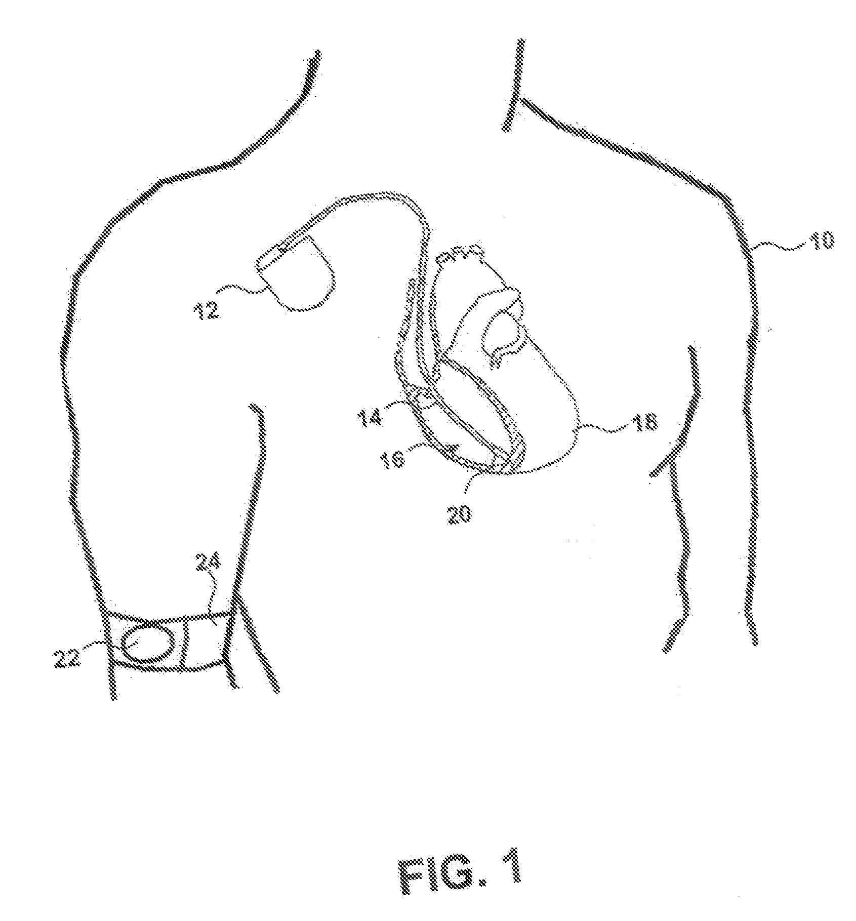 Implantable electromagnetic interference tolerant, wired sensors and methods for implementing same