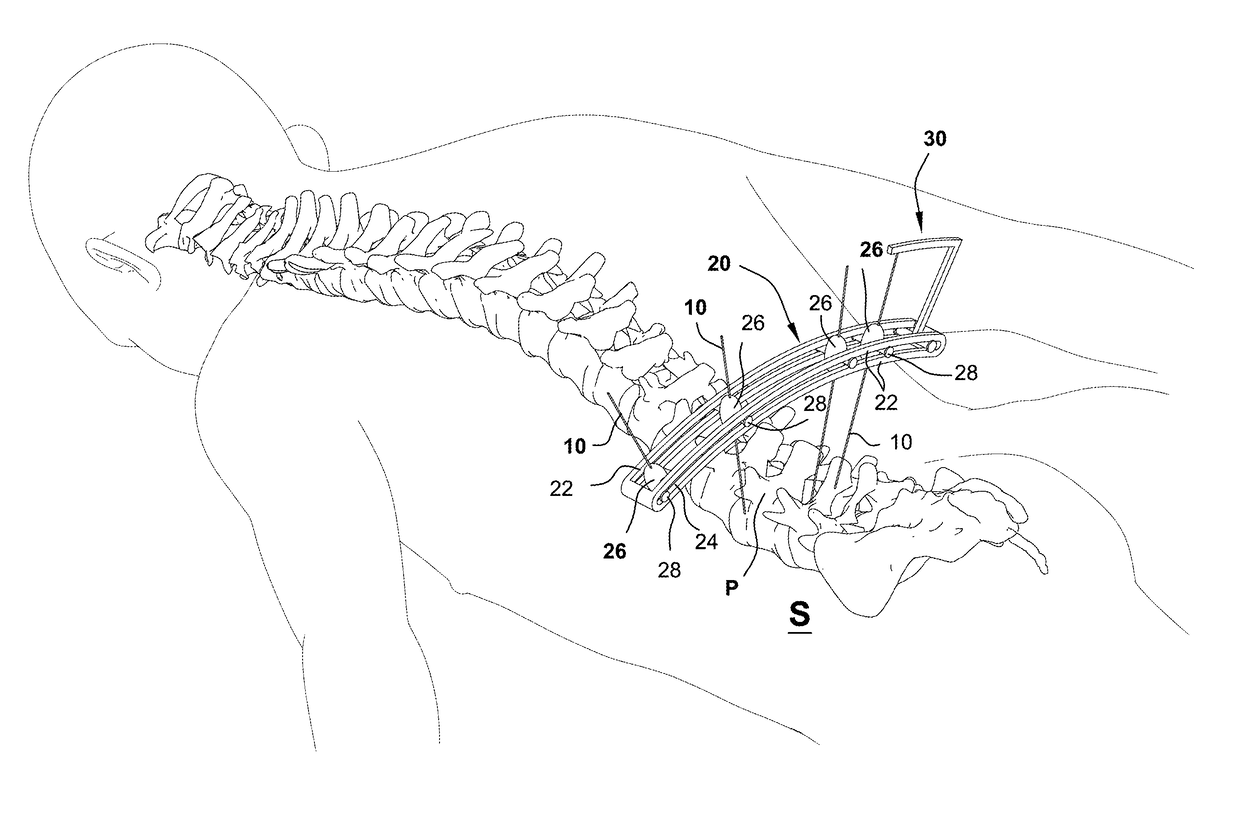 Intraoperative fluoroscopic registration of vertebral bodies