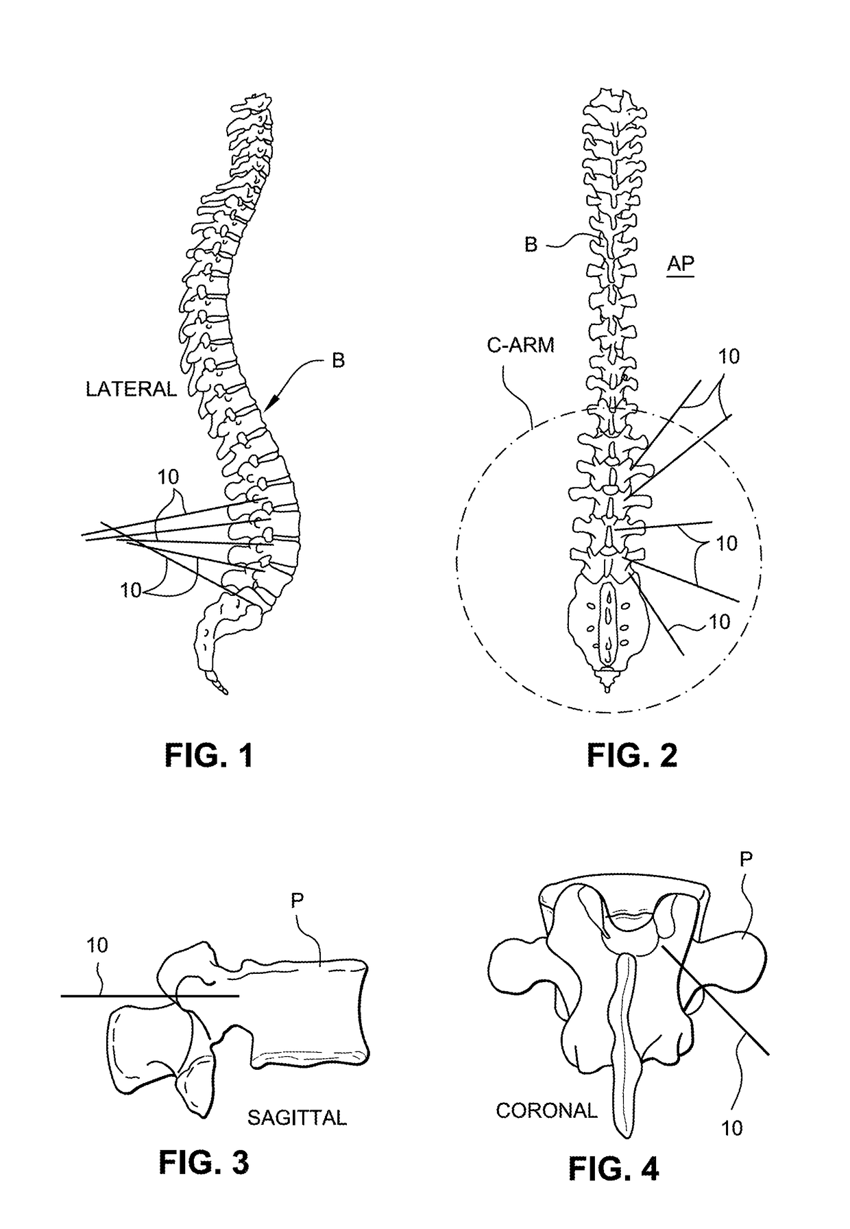 Intraoperative fluoroscopic registration of vertebral bodies