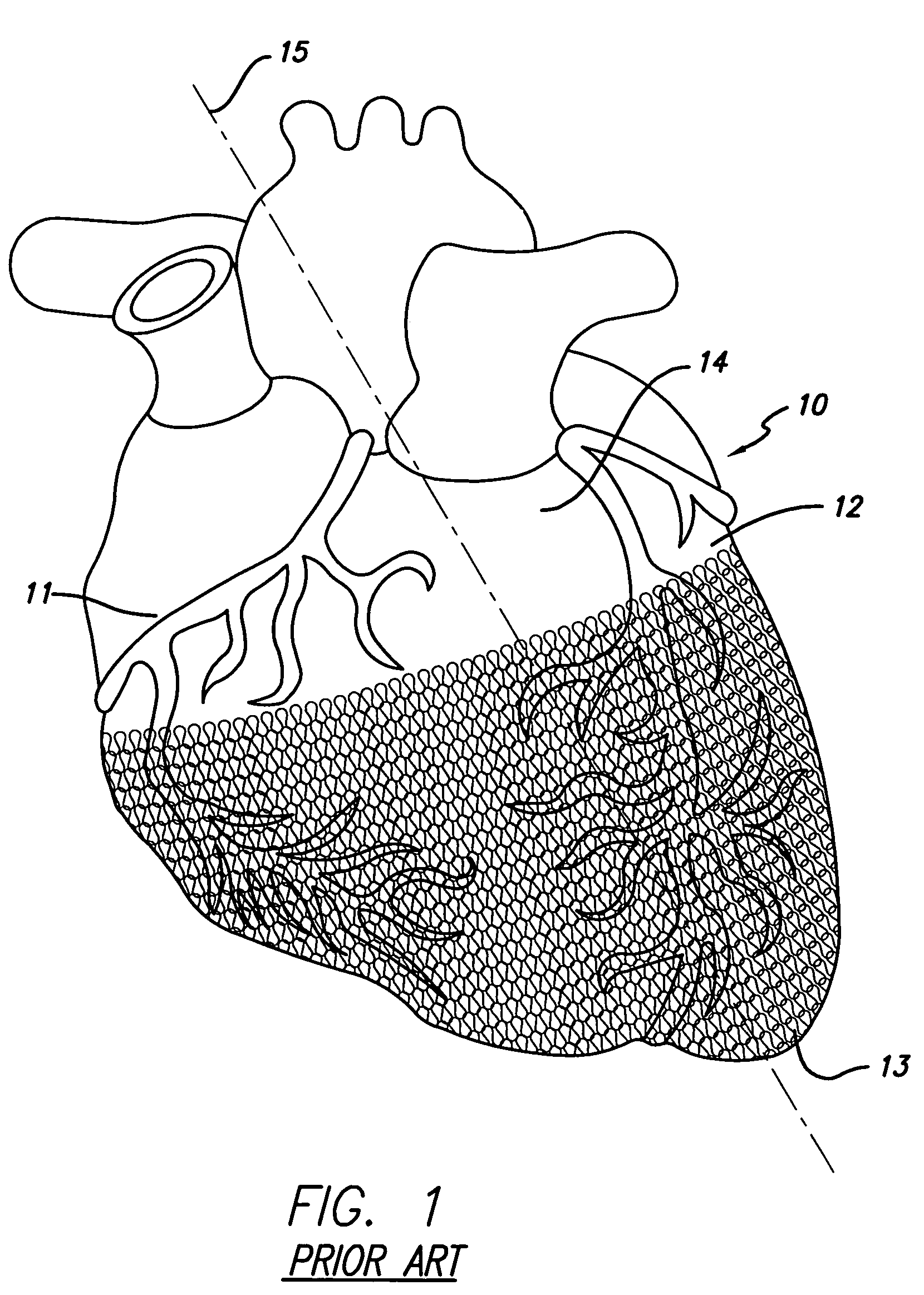 Cardiac harness for treating congestive heart failure and for defibrillating and/or pacing/sensing