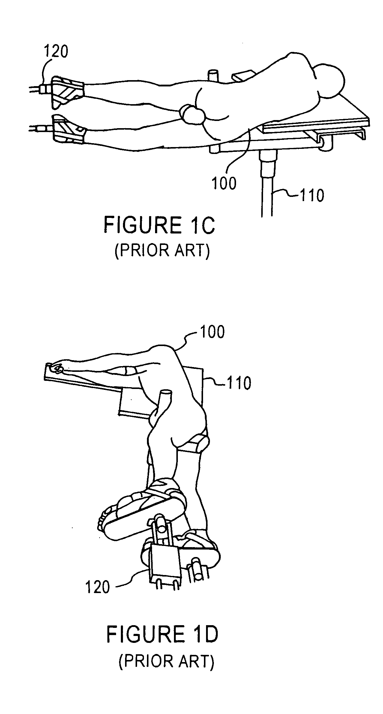 Surgical intramedullary implant with improved locking for fixation of fractured bone segments