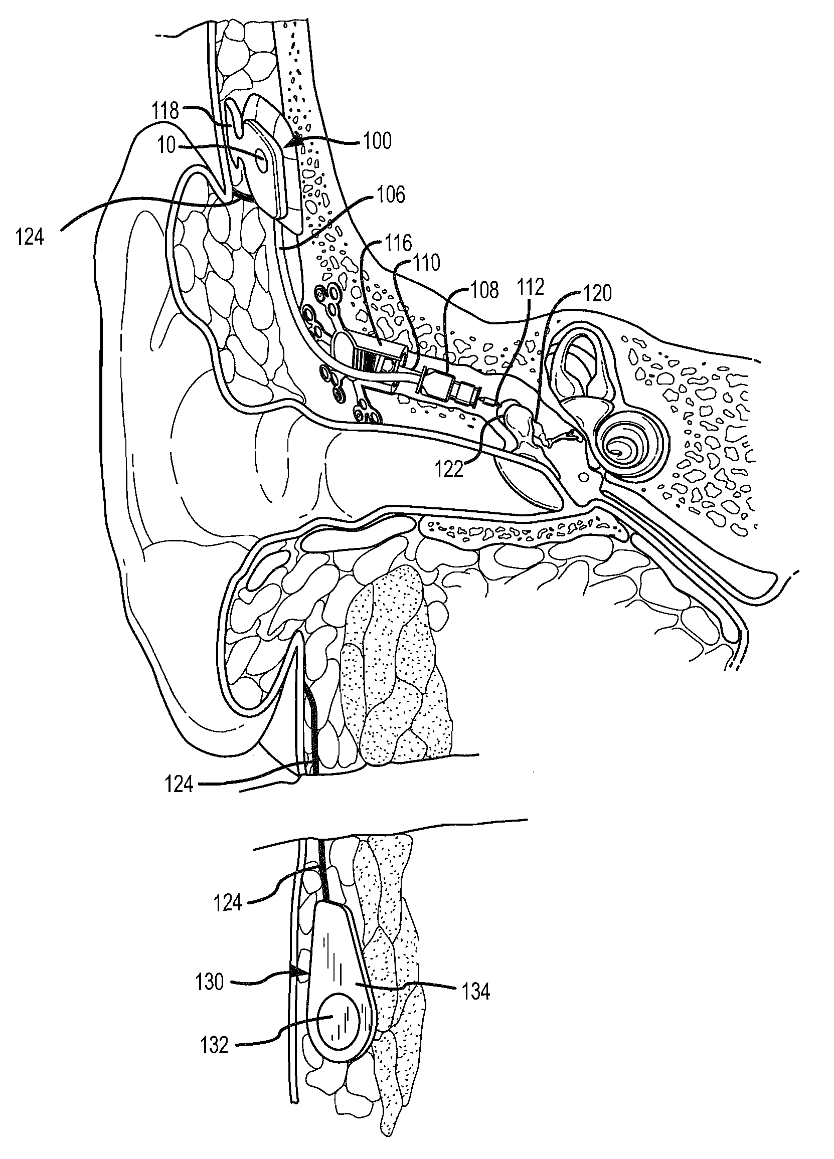 Soft tissue placement of implantable microphone