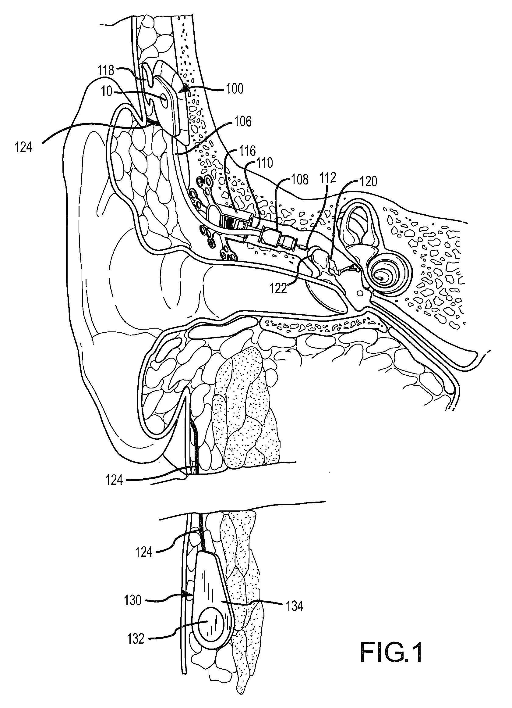 Soft tissue placement of implantable microphone