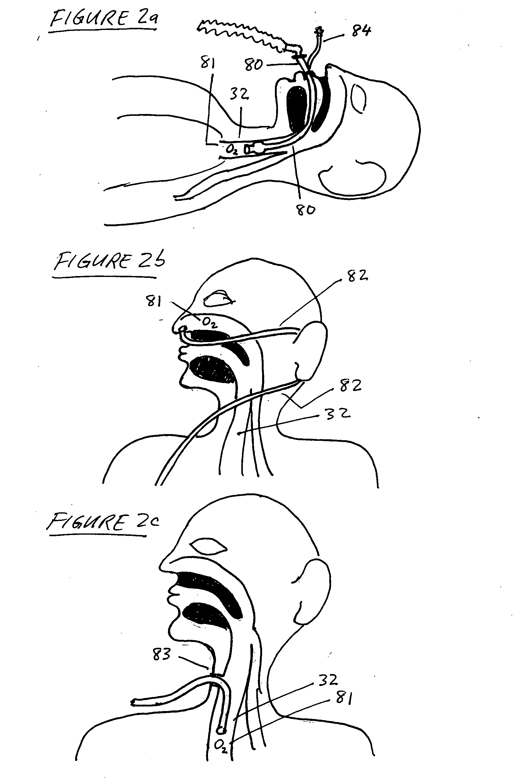 Methods, systems and devices for improving ventilation in a lung area