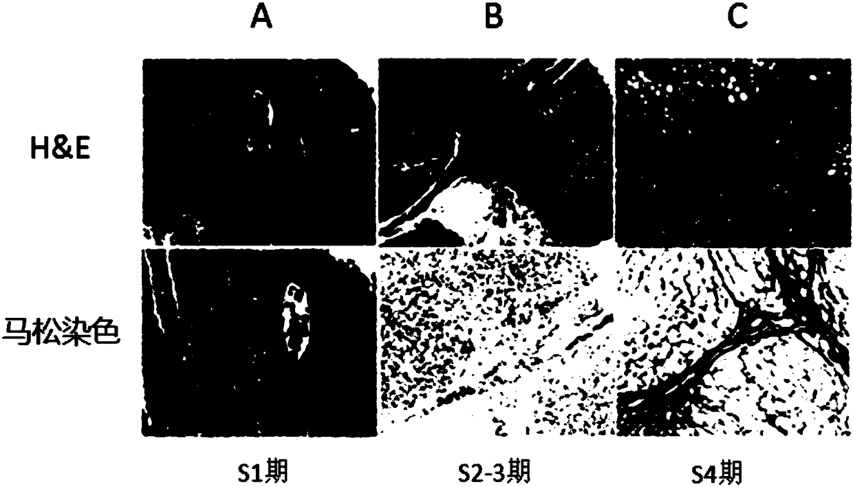 Medicine and treatment method for treating hepatic fibrosis