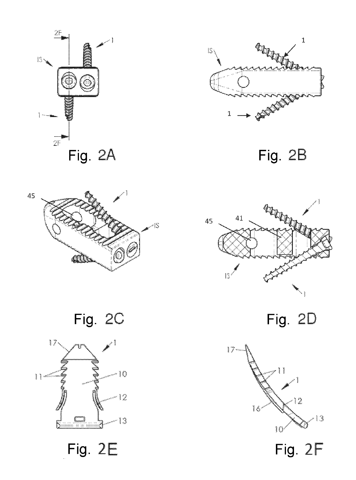 System of spinal arthodesis implants