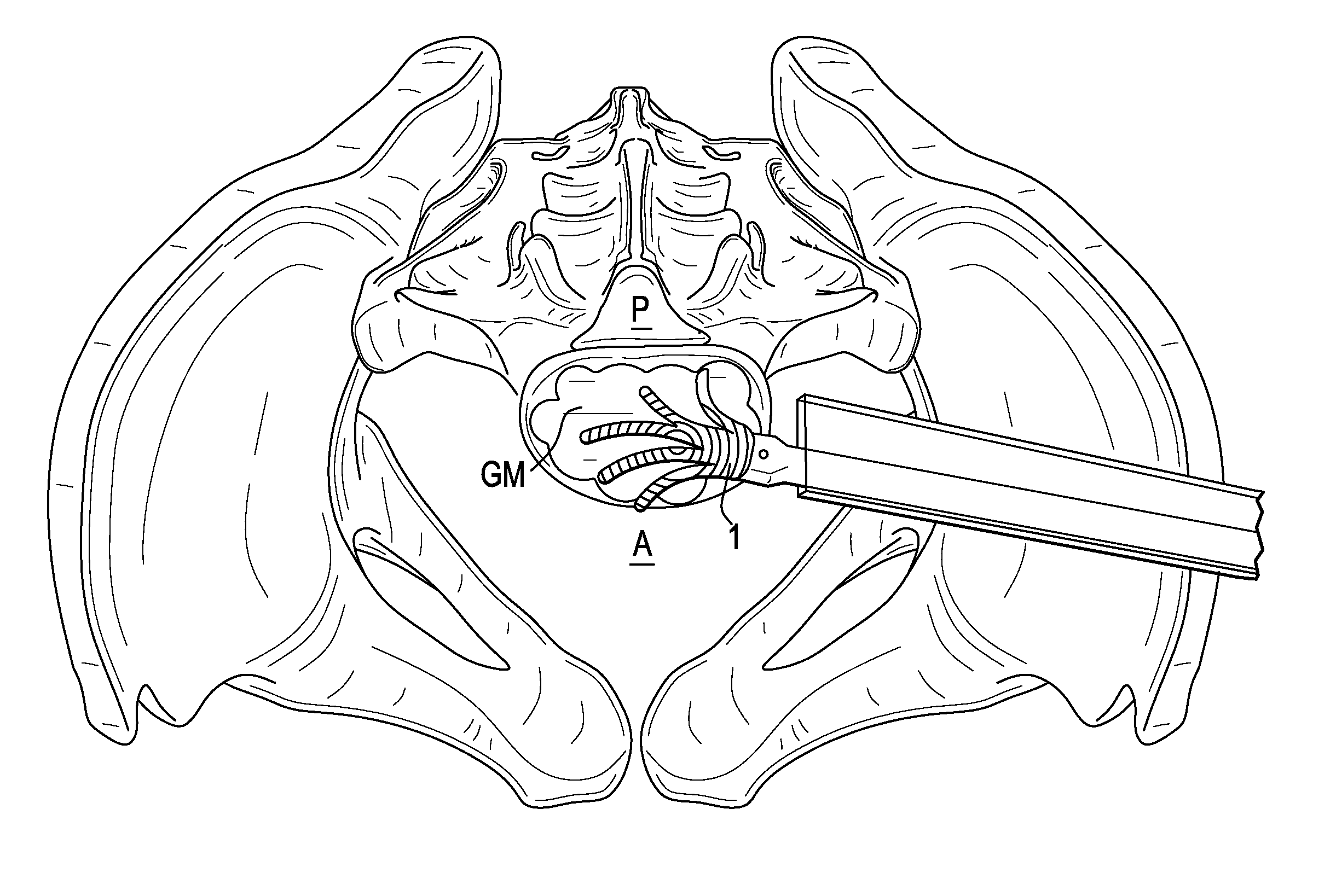 Surface expanding spacer