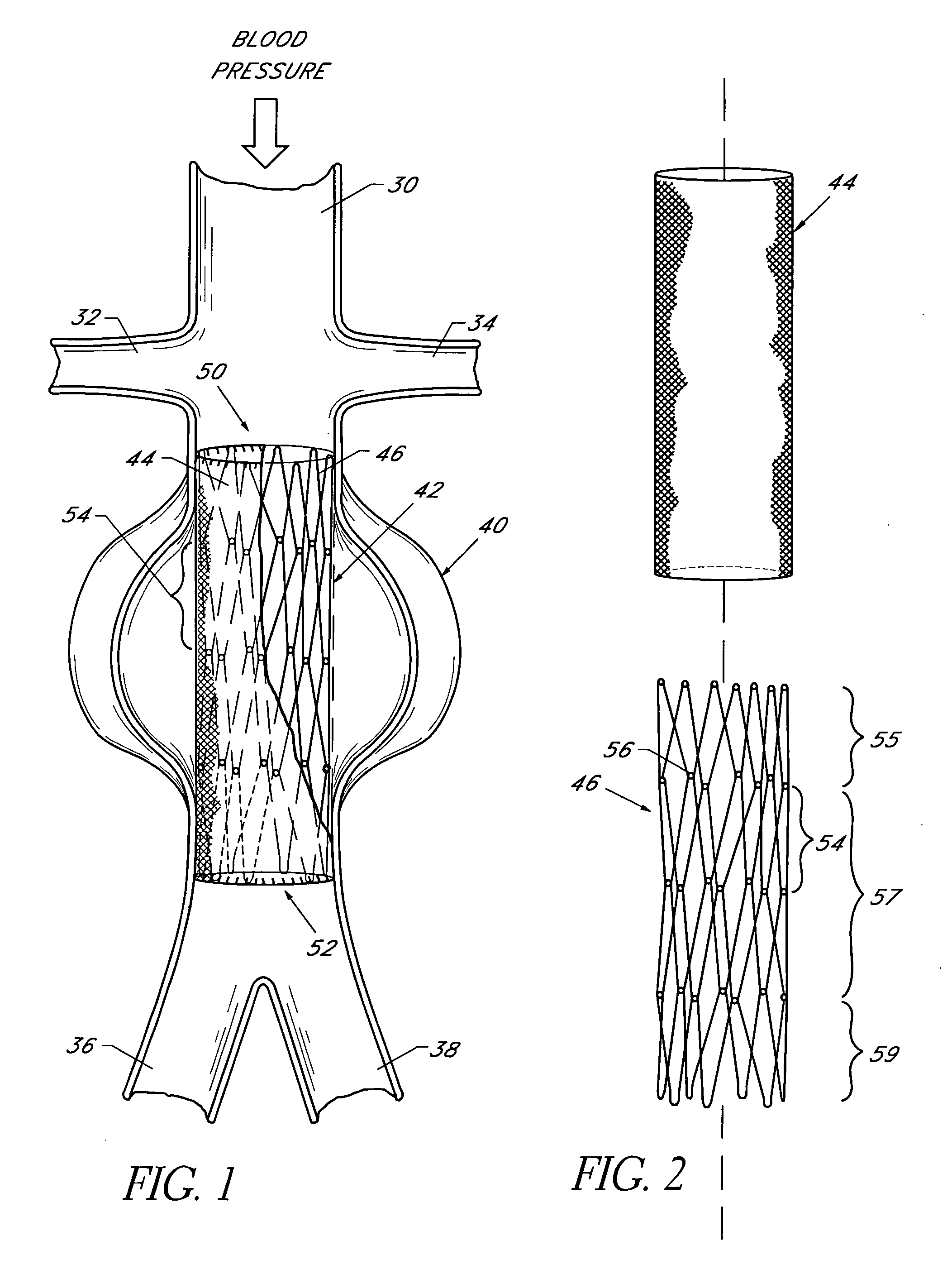 Endolumenal vascular prosthesis with neointima inhibiting polymeric sleeve