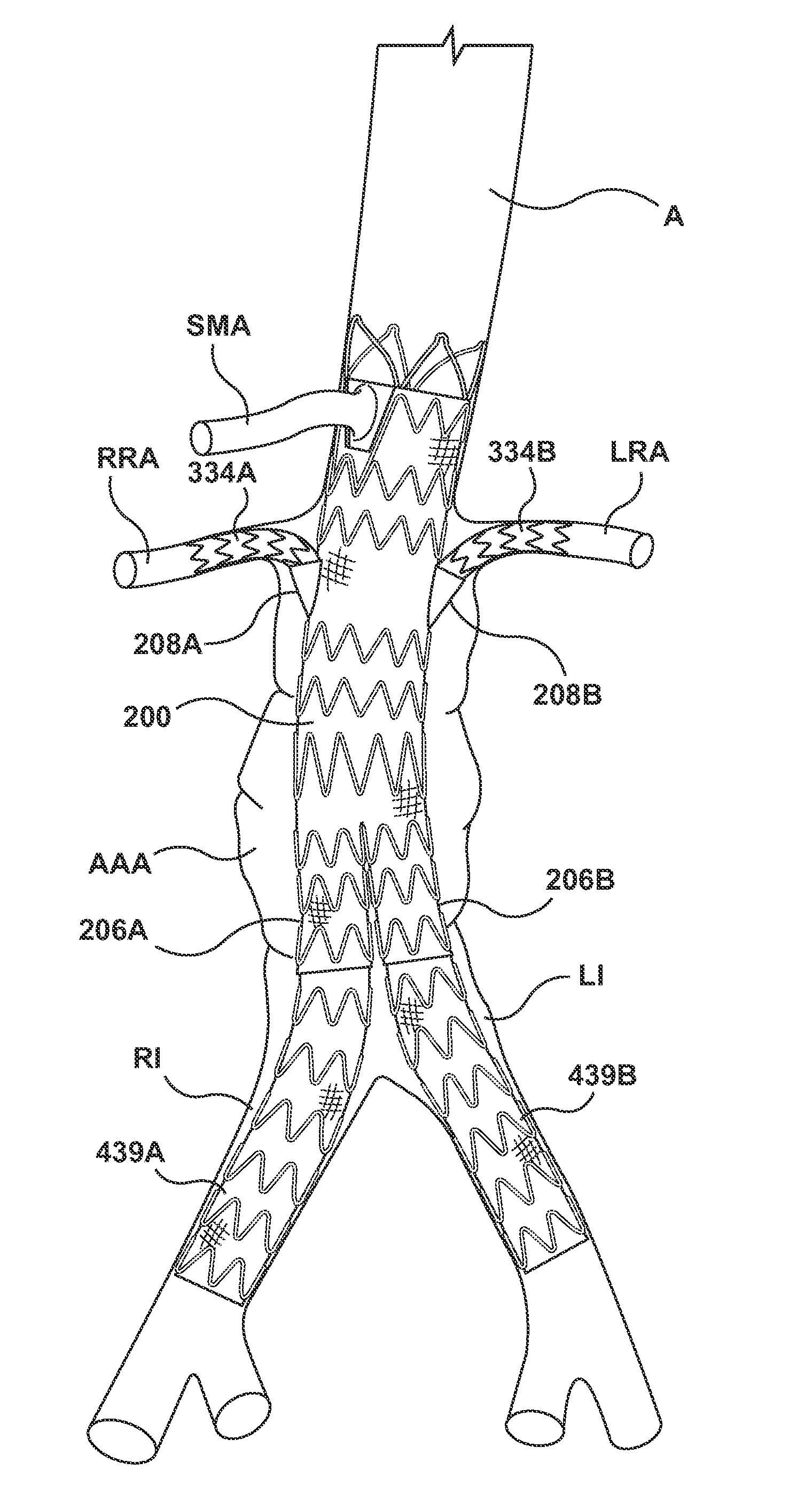 Stent-graft prosthesis for placement in the abdominal aorta