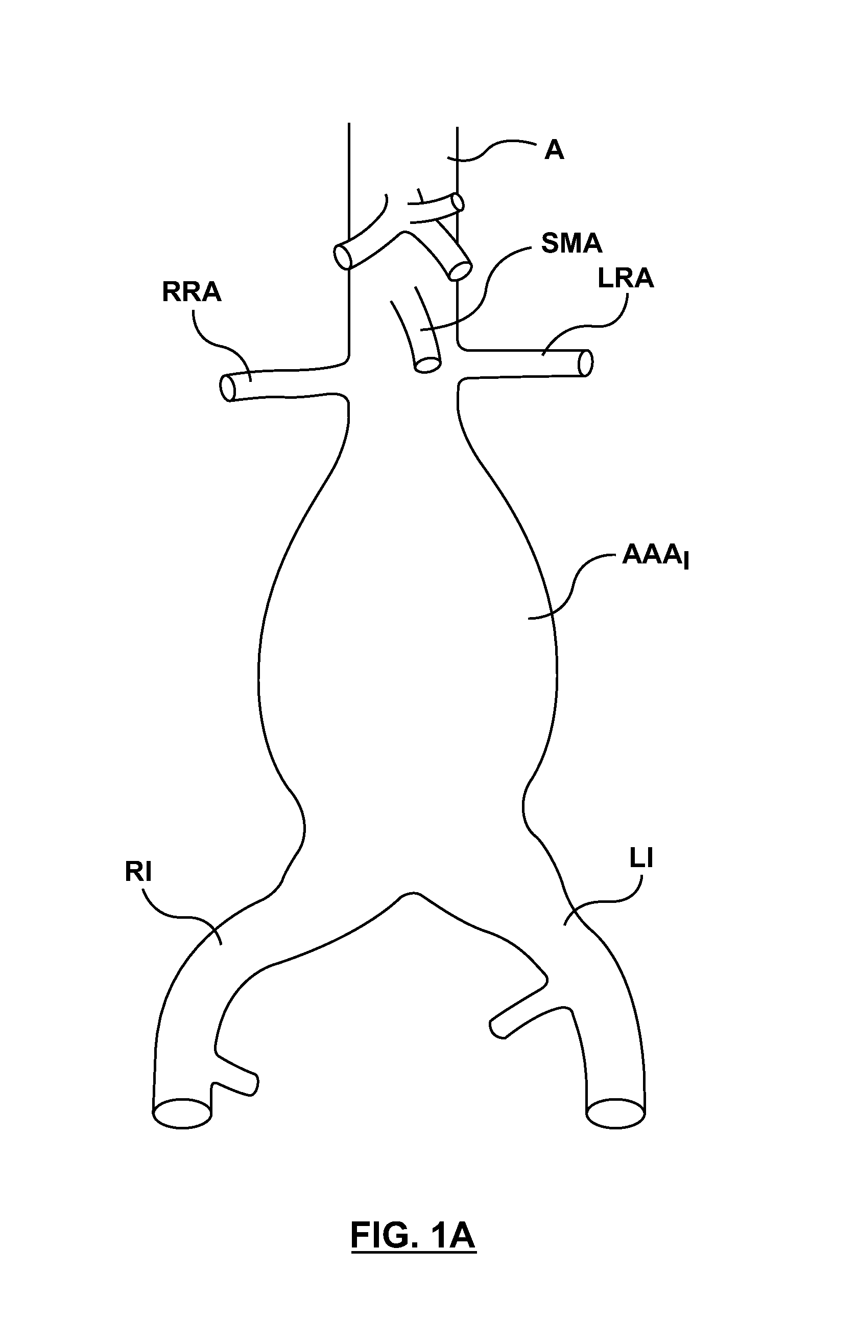 Stent-graft prosthesis for placement in the abdominal aorta