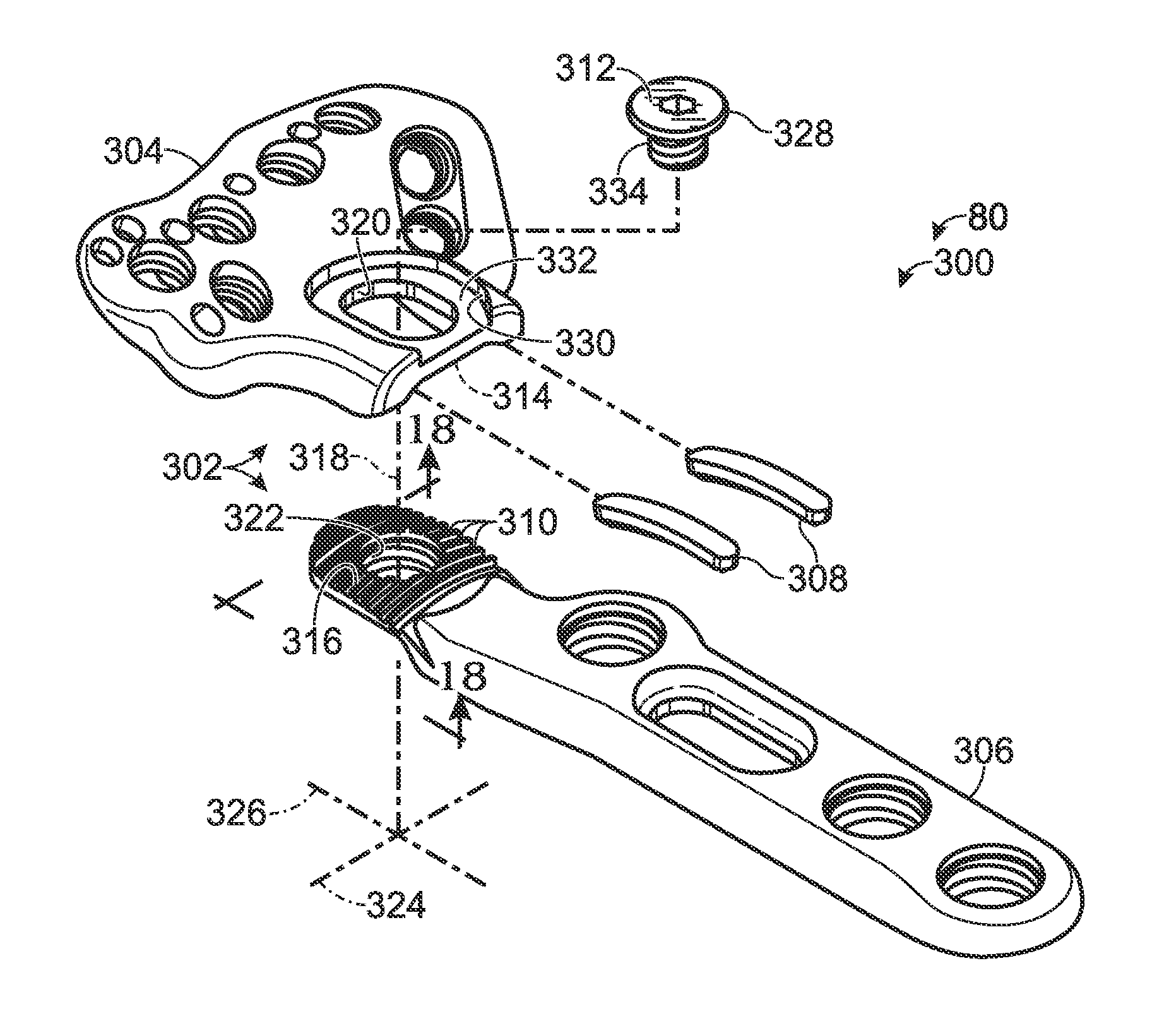 Bone plate with movable joint