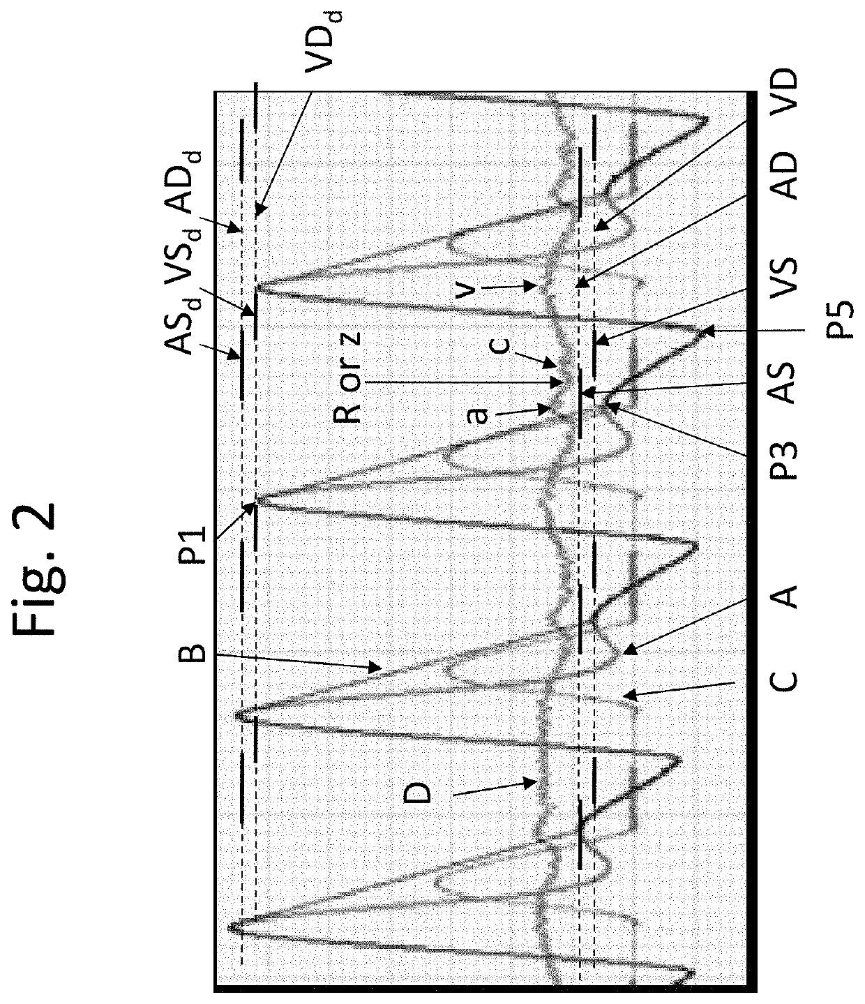 Monitoring cardiac blood flow balance relationship between the right and left heart chambers and cardiac regulation