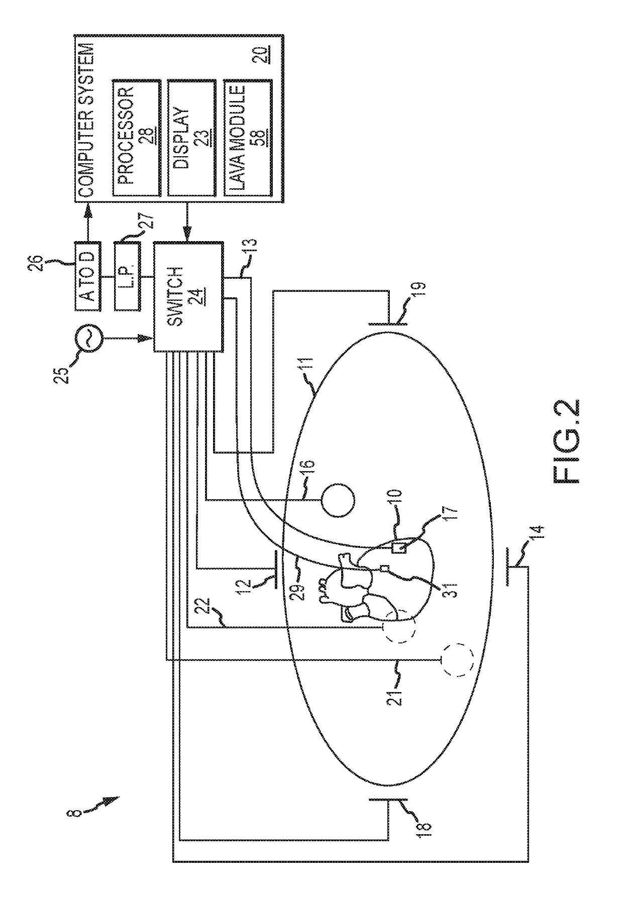 Methods and systems for statistically analyzing electrograms for local abnormal ventricular activities and mapping the same