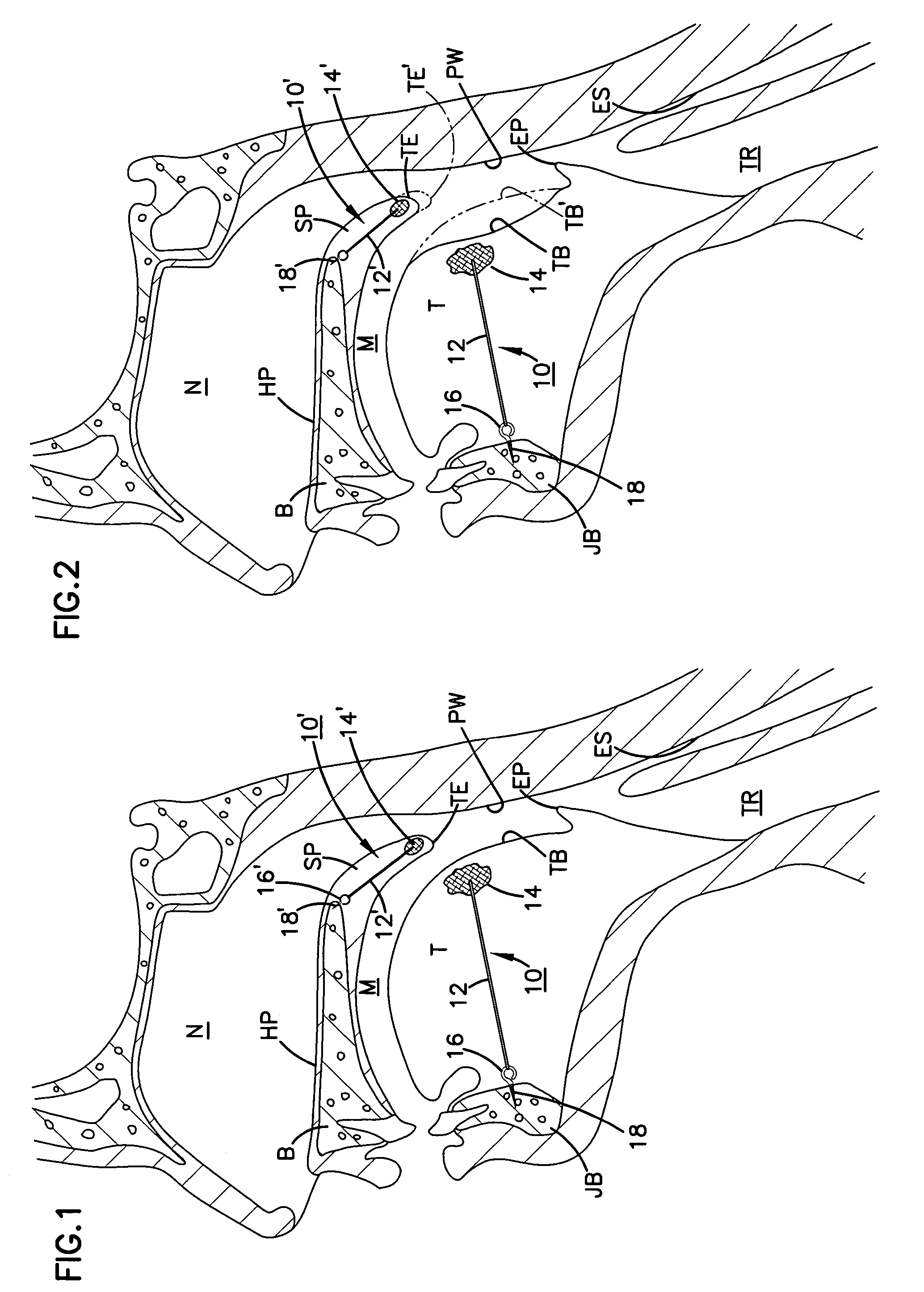 Implant for tongue