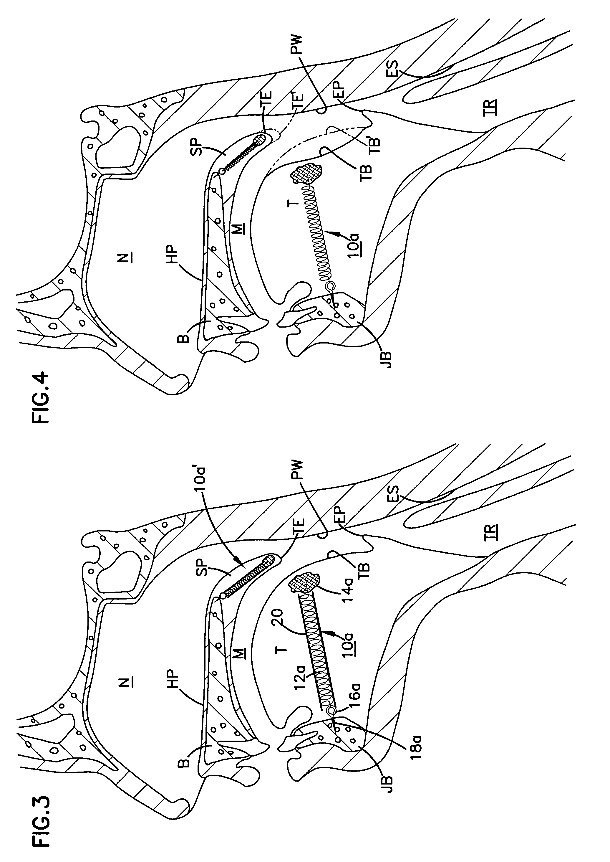 Implant for tongue