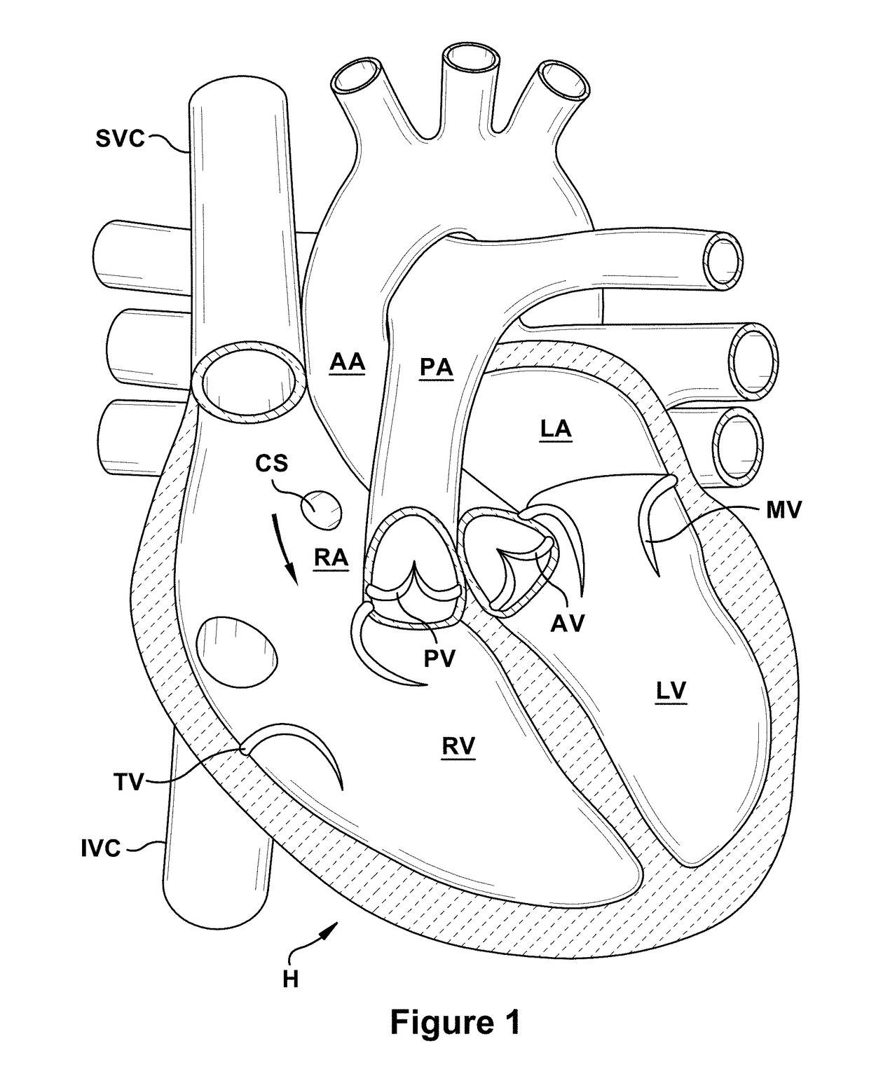 Native valve repair devices and procedures