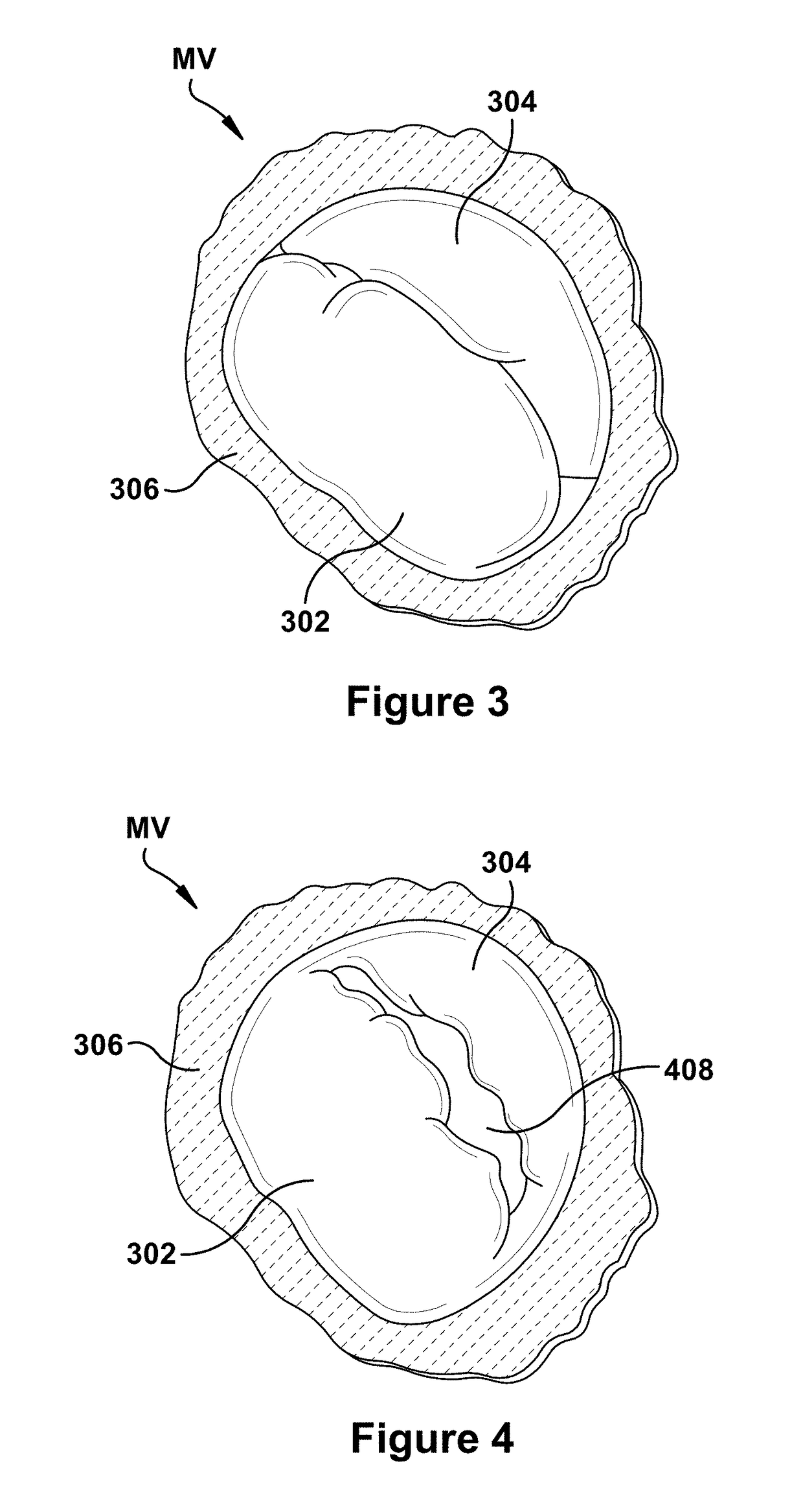 Native valve repair devices and procedures