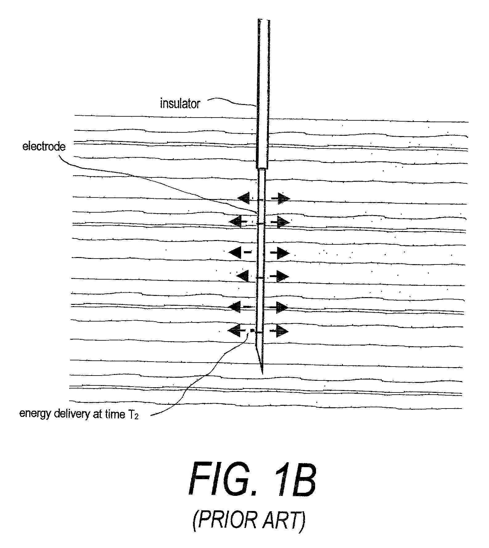 Electrosurgical working end for controlled energy delivery