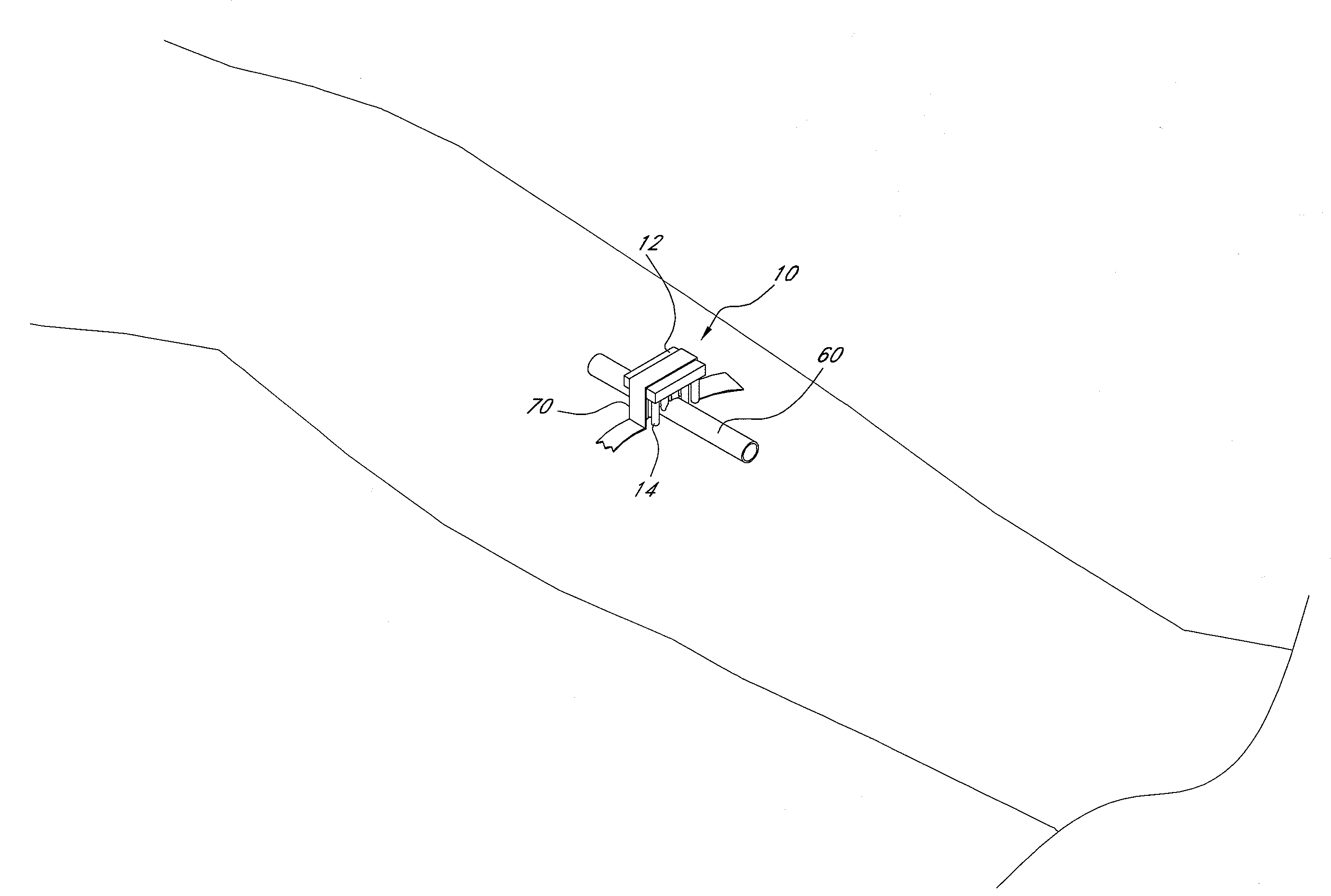 Securement system for a medical article