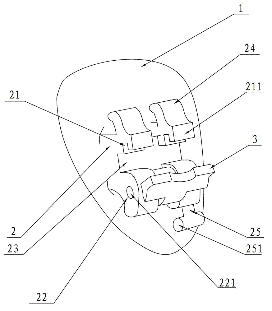 Individual tongue side self-locking appliance