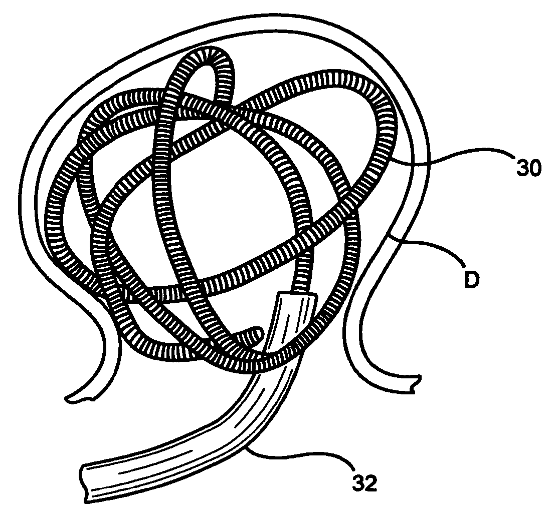 Methods of, and materials for, treating vascular defects with magnetically controllable hydrogels