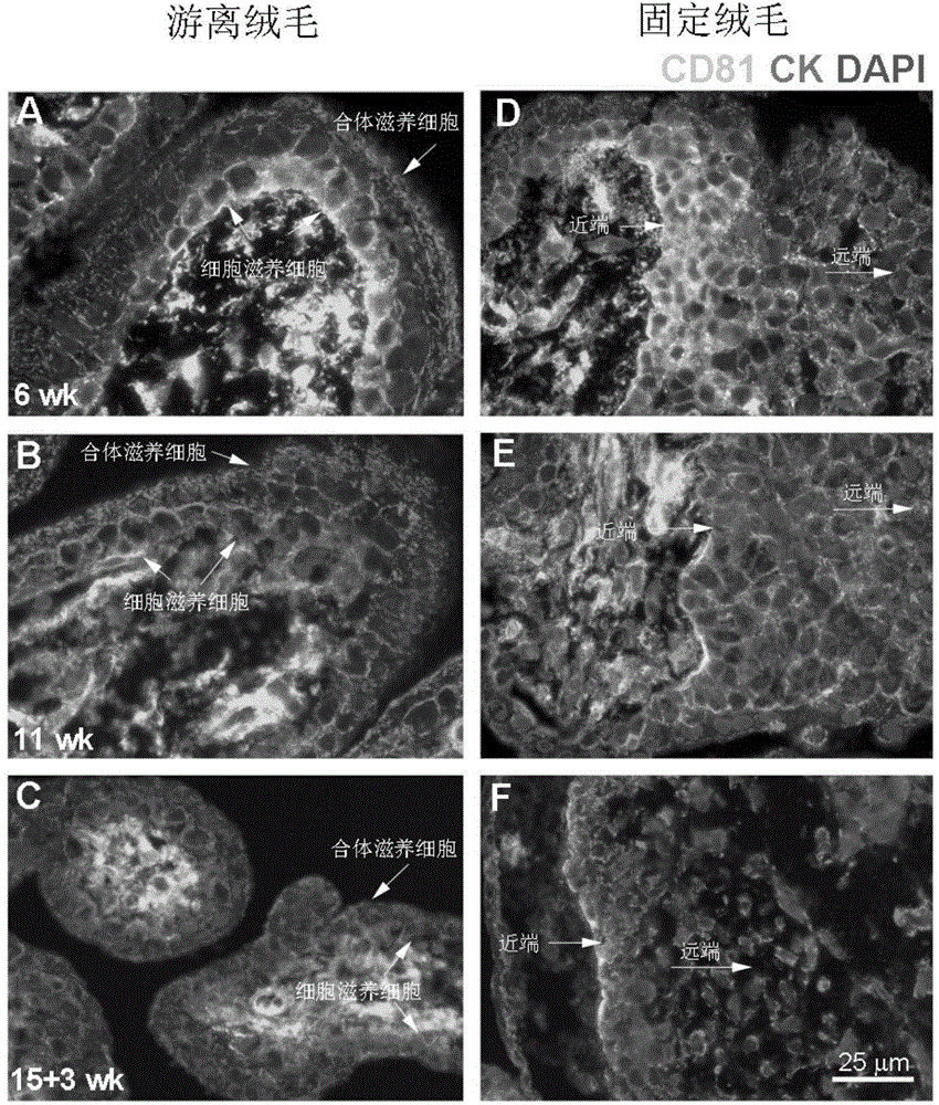 Application of membrane protein CD81 in early forecasting, parting, diagnosis and treatment of eclampsia