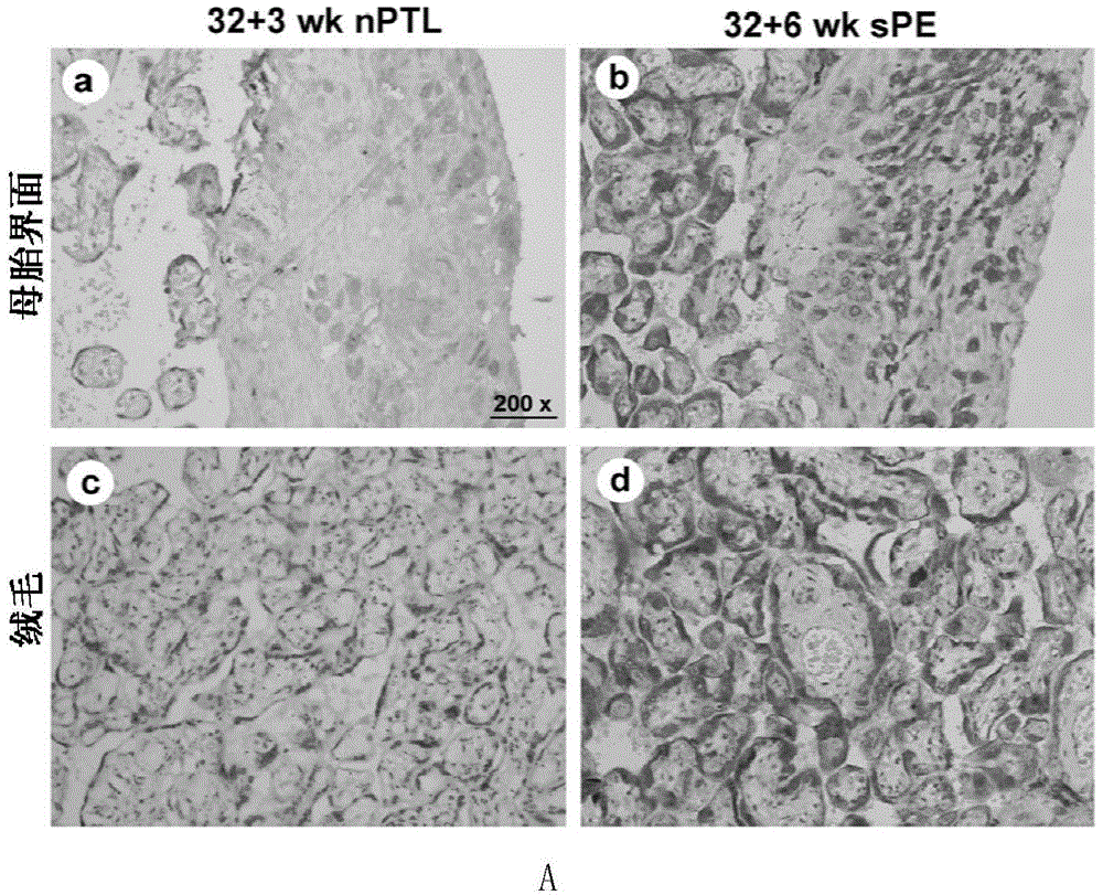 Application of membrane protein CD81 in early forecasting, parting, diagnosis and treatment of eclampsia