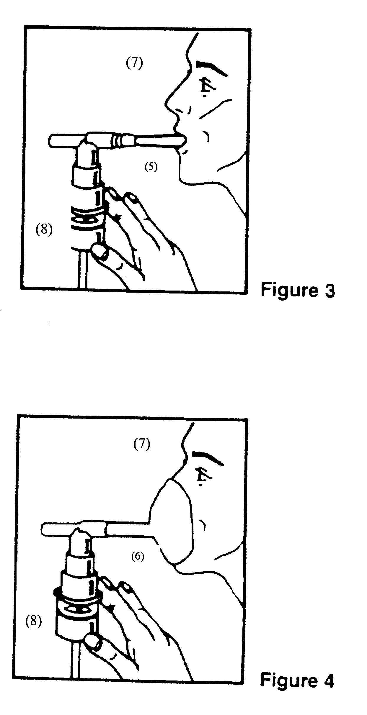 Albuterol and ipratropium inhalation solution, system, kit and method for relieving symptoms of chronic obstructive pulmonary disease